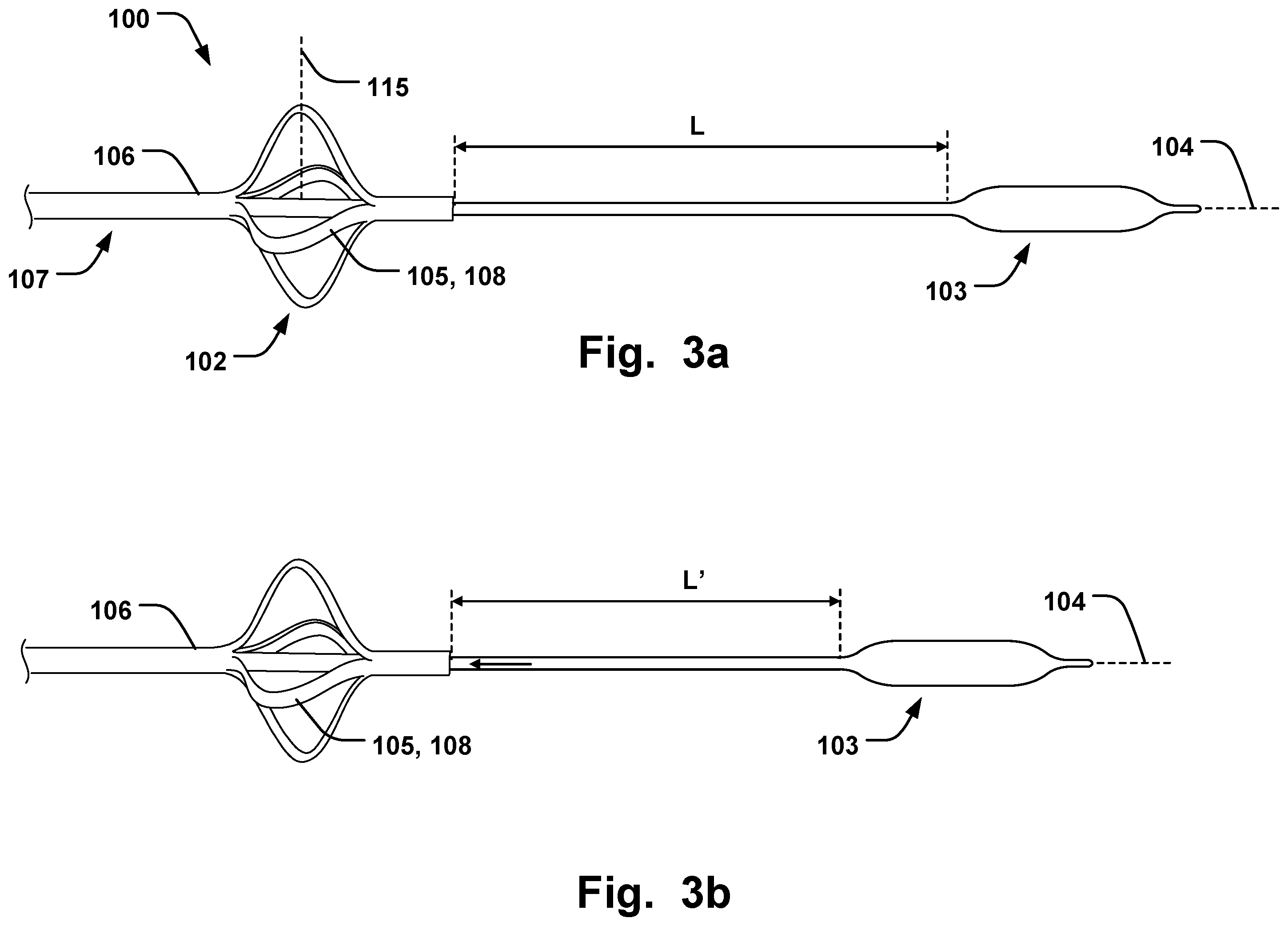 Patent US11793641 Figure 3 – Medical system for annuloplasty
