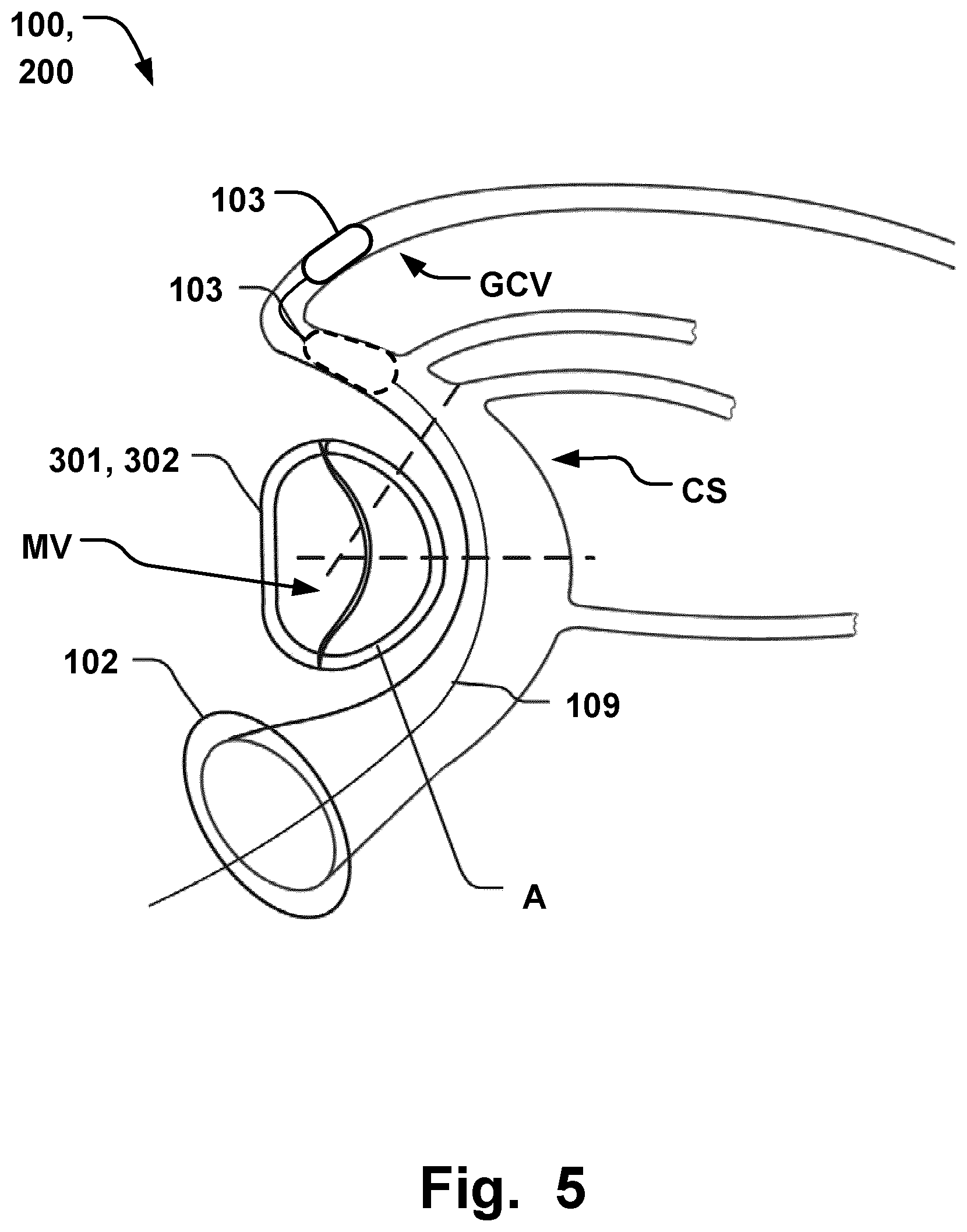 Patent US11793641 Figure 5 – Medical system for annuloplasty