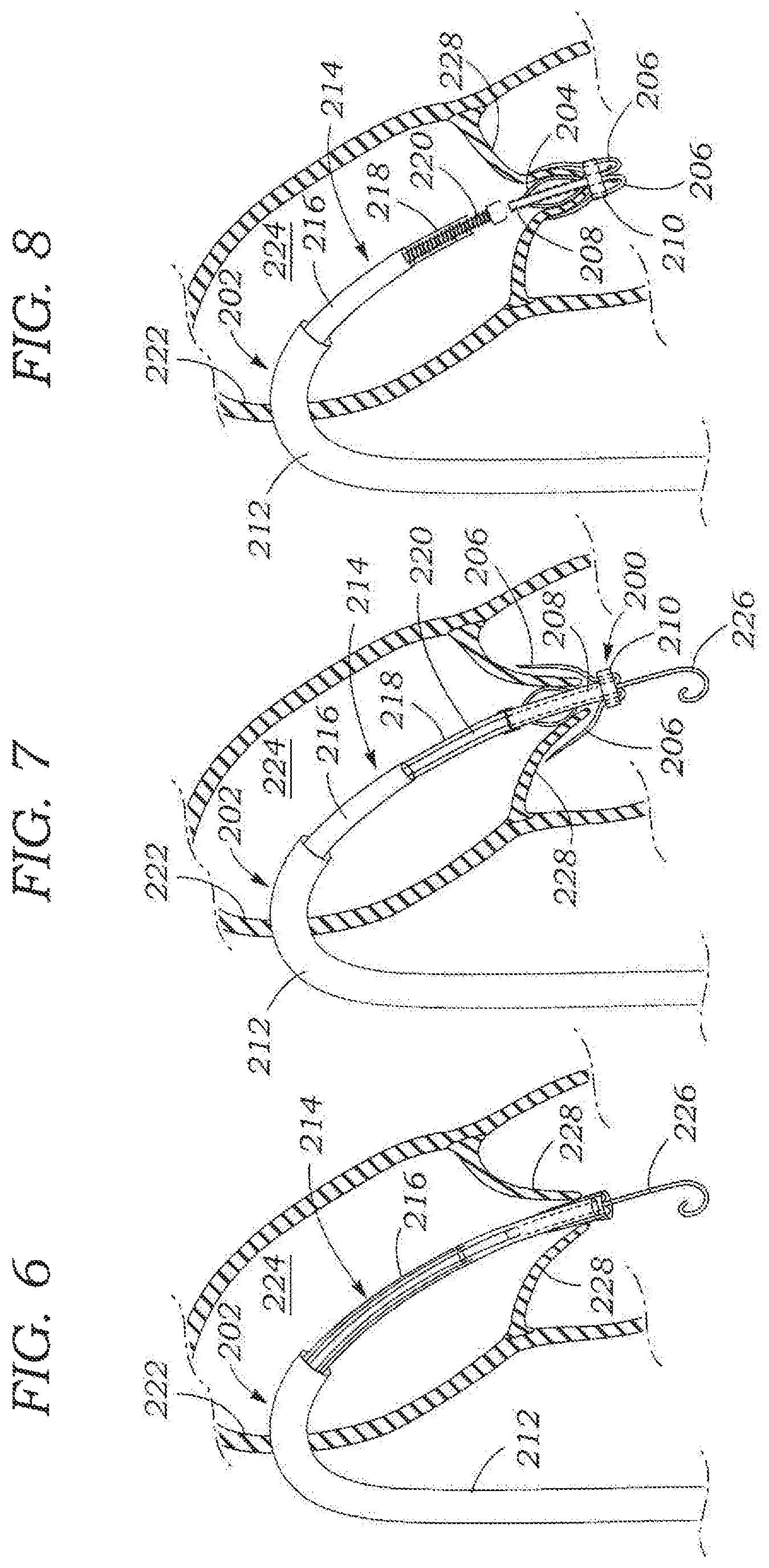 Patent US11793642 Figure 3 – Heart valve sealing devices and delivery devices therefor