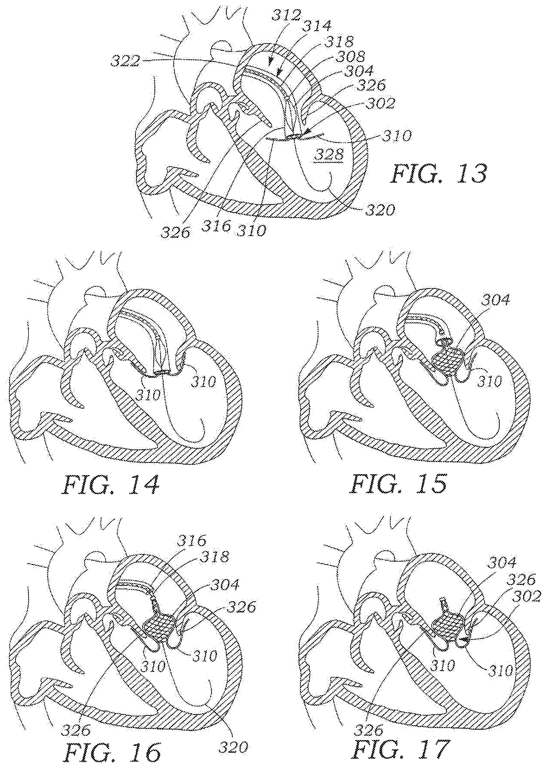 Patent US11793642 Figure 6 – Heart valve sealing devices and delivery devices therefor