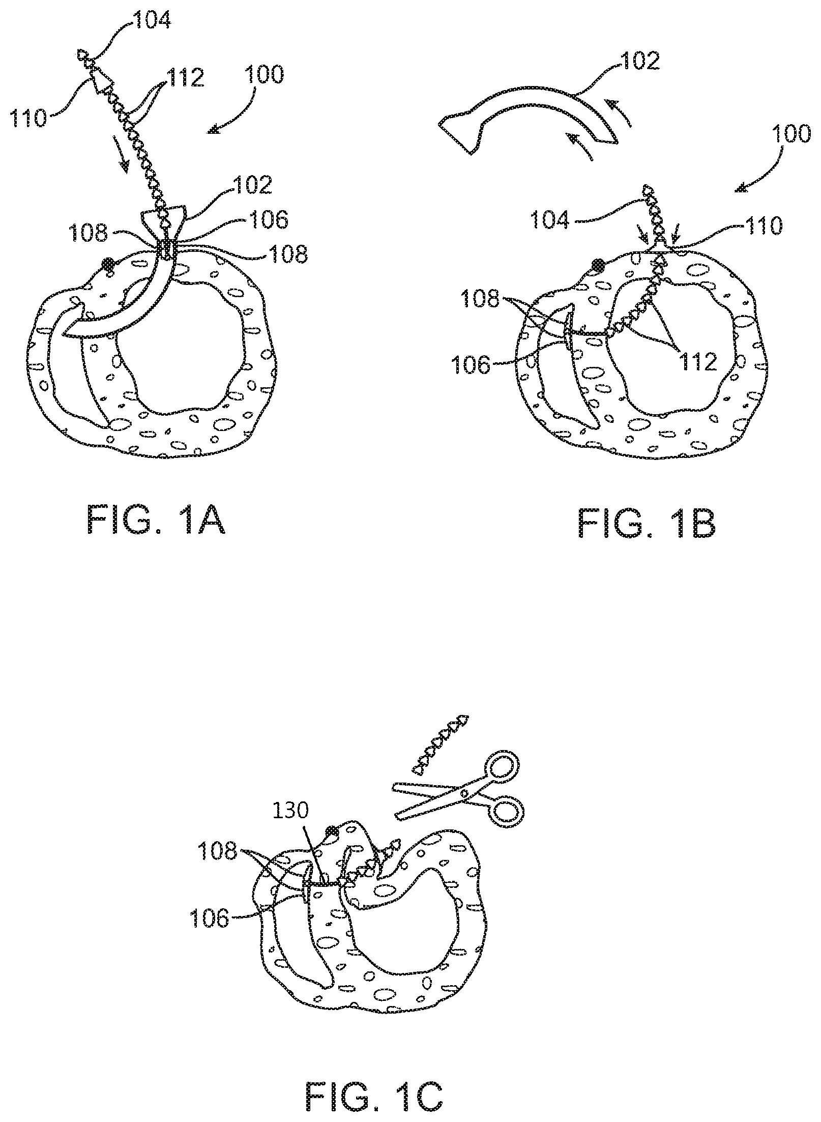 Patent US11793643 Figure 1 – Method and apparatus for closing off a portion of a heart ventricle