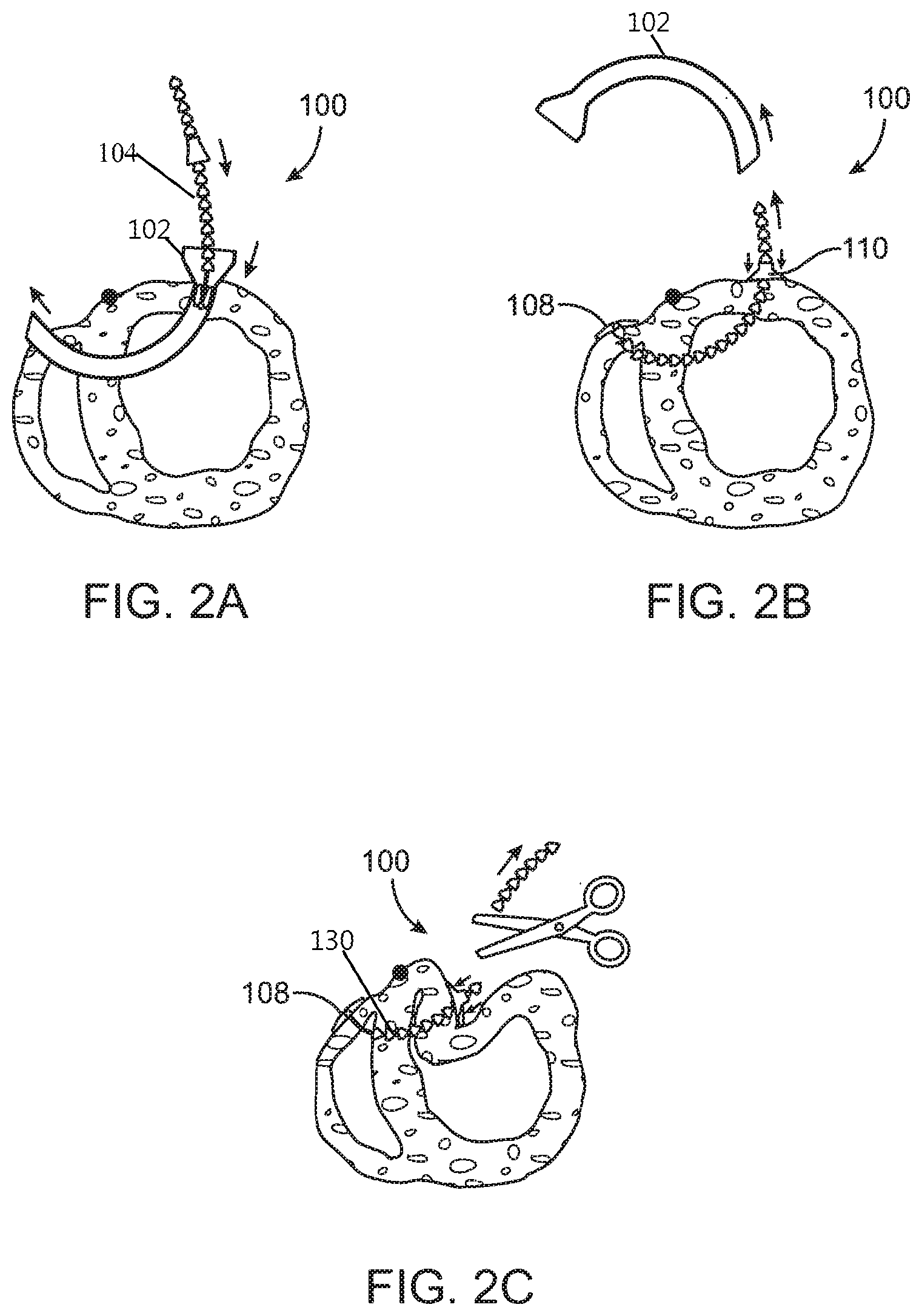 Patent US11793643 Figure 2 – Method and apparatus for closing off a portion of a heart ventricle