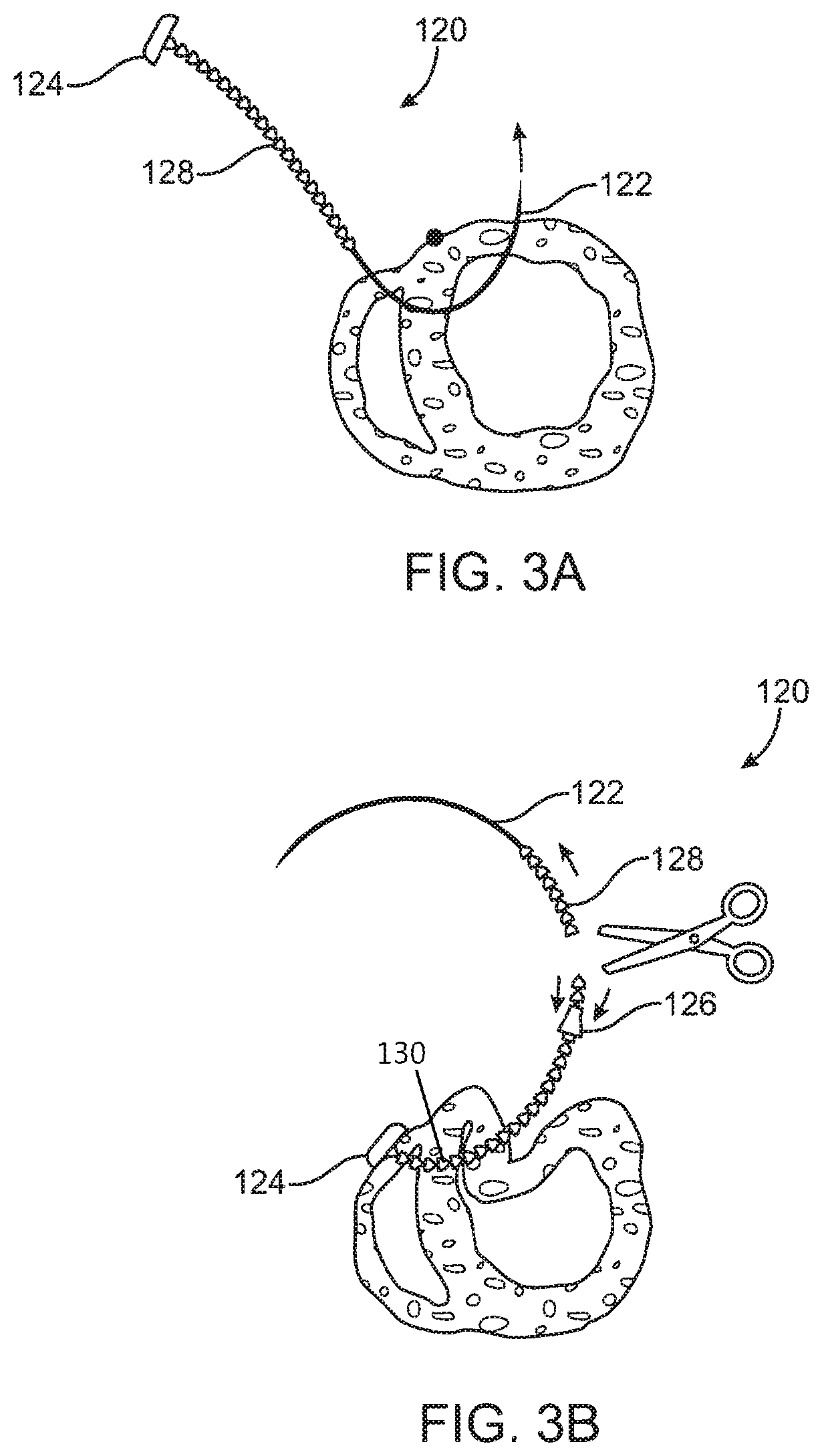Patent US11793643 Figure 3 – Method and apparatus for closing off a portion of a heart ventricle