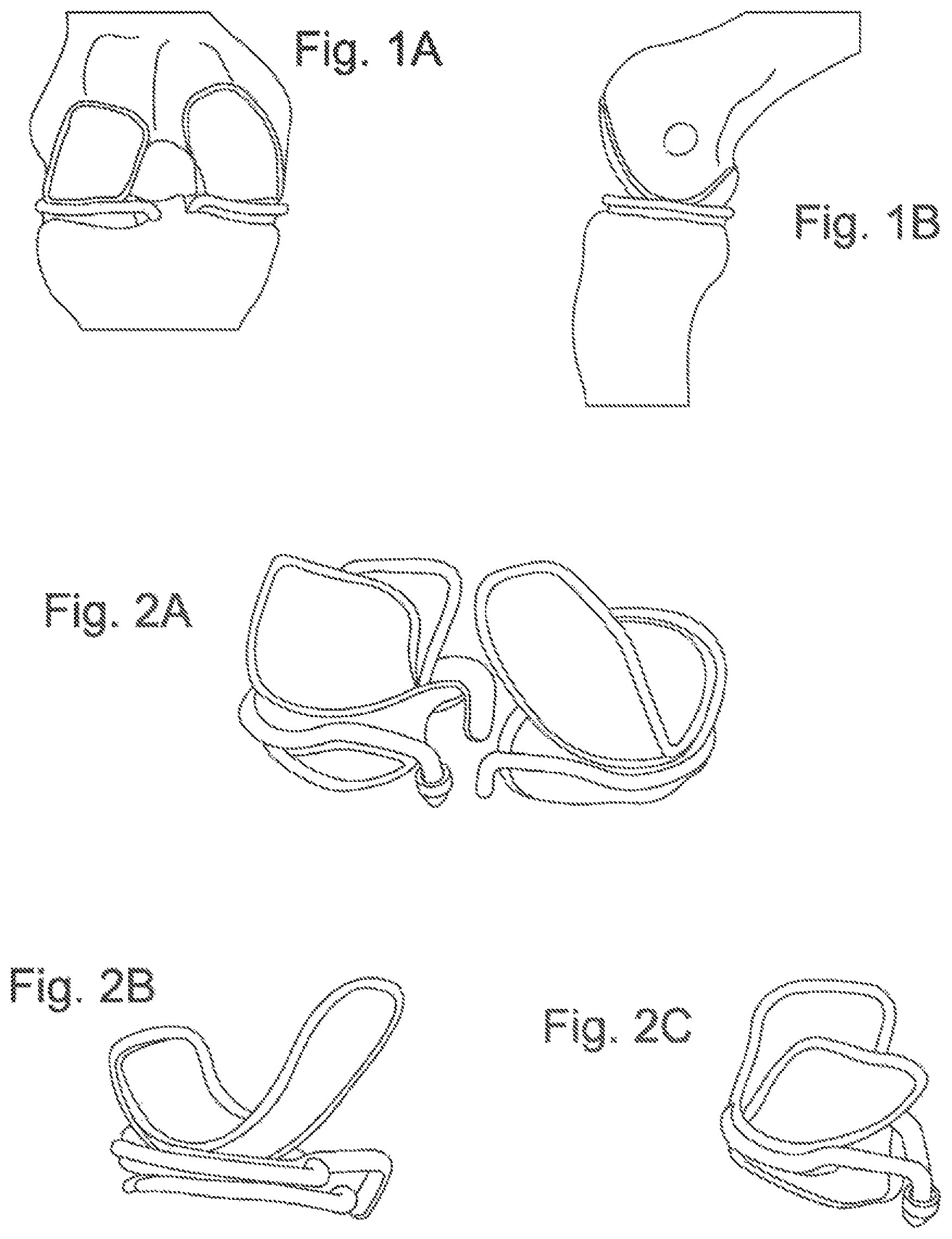 Patent US11793646 — Rigid segmented flexible anchors — Figure 1