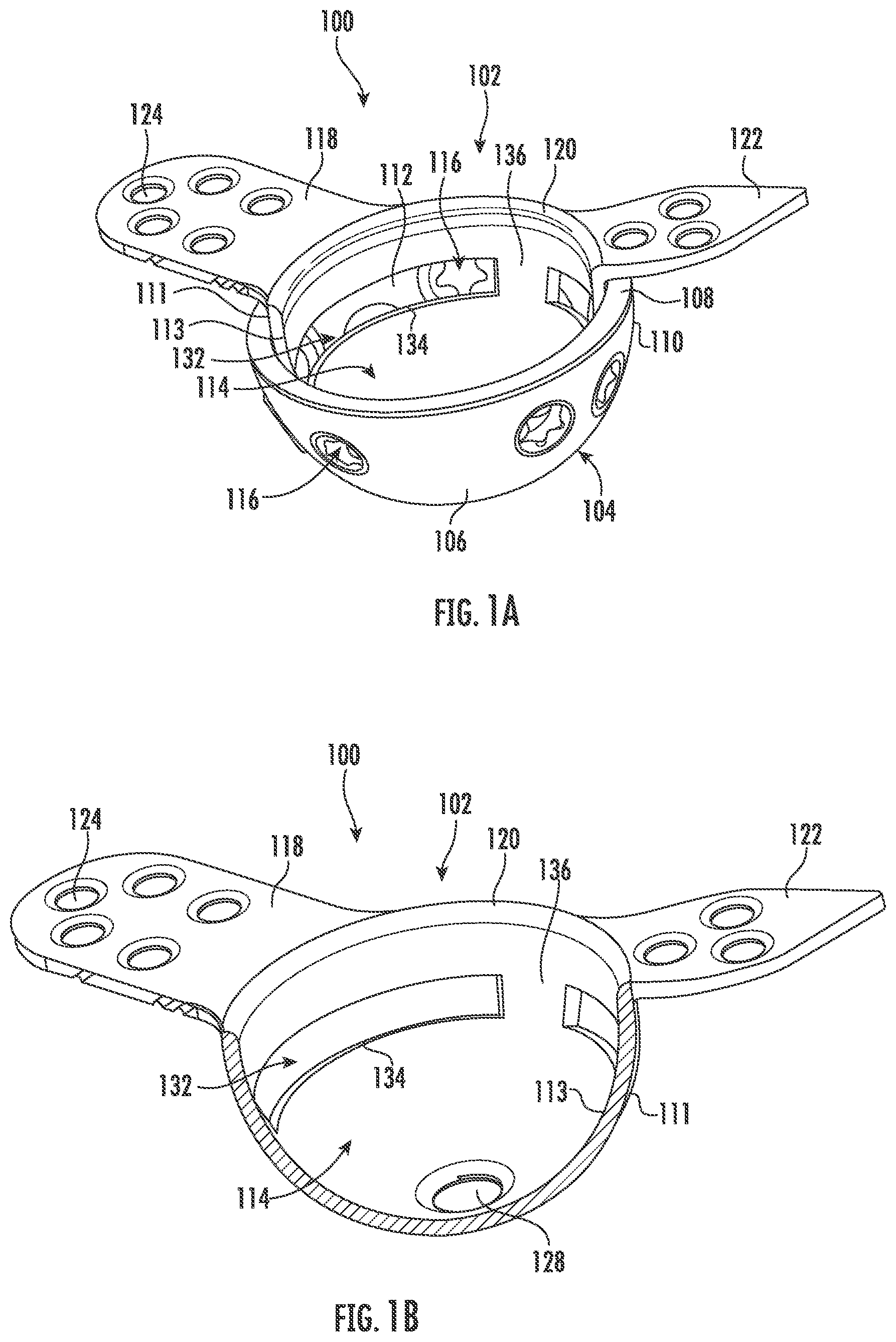 Patent US11793647 Figure 1 – Acetabular apparatuses for hip revision surgery