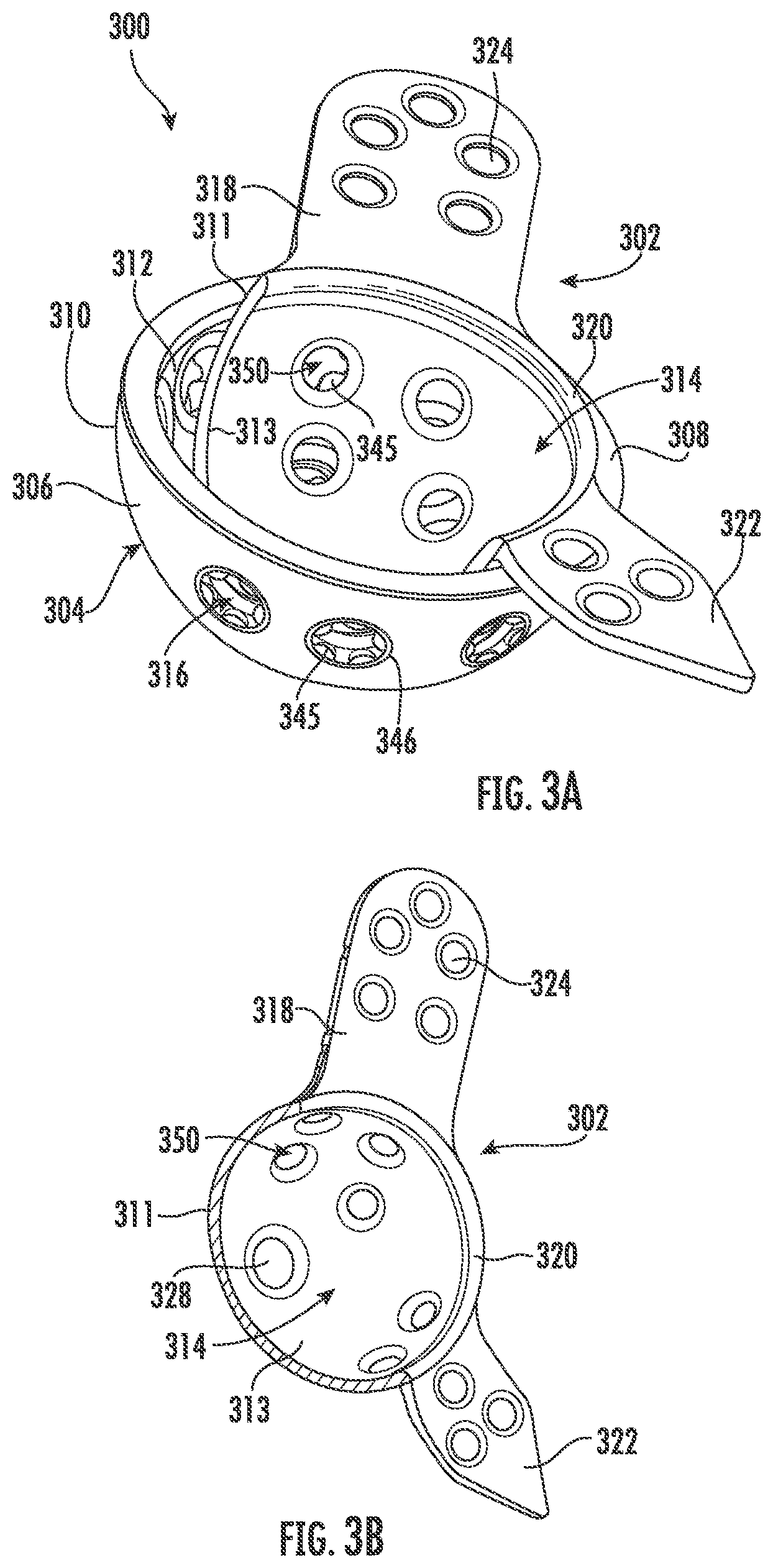 Patent US11793647 Figure 5 – Acetabular apparatuses for hip revision surgery