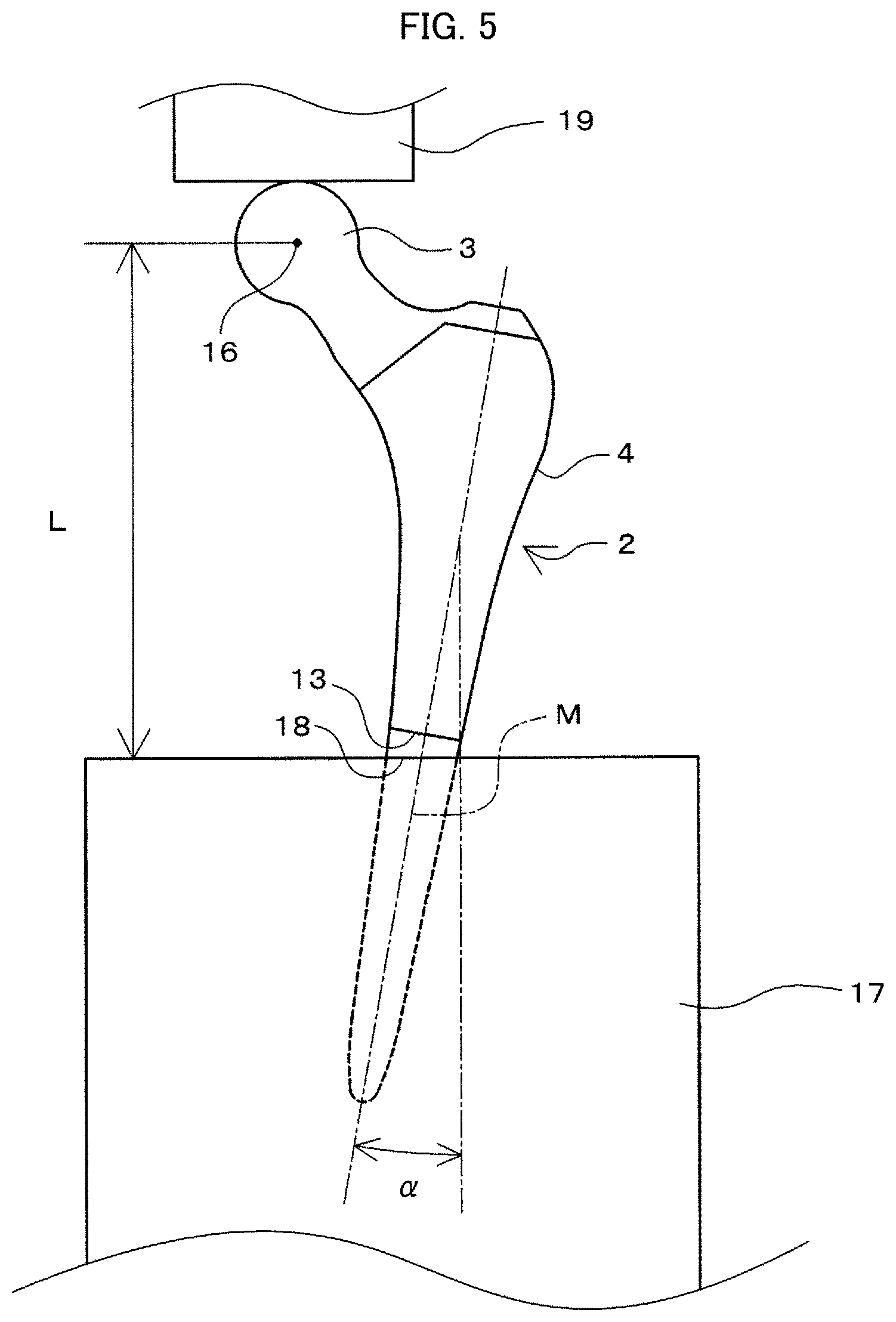 Patent US11793648 Figure 5 – Prosthetic joint and manufacturing method for same