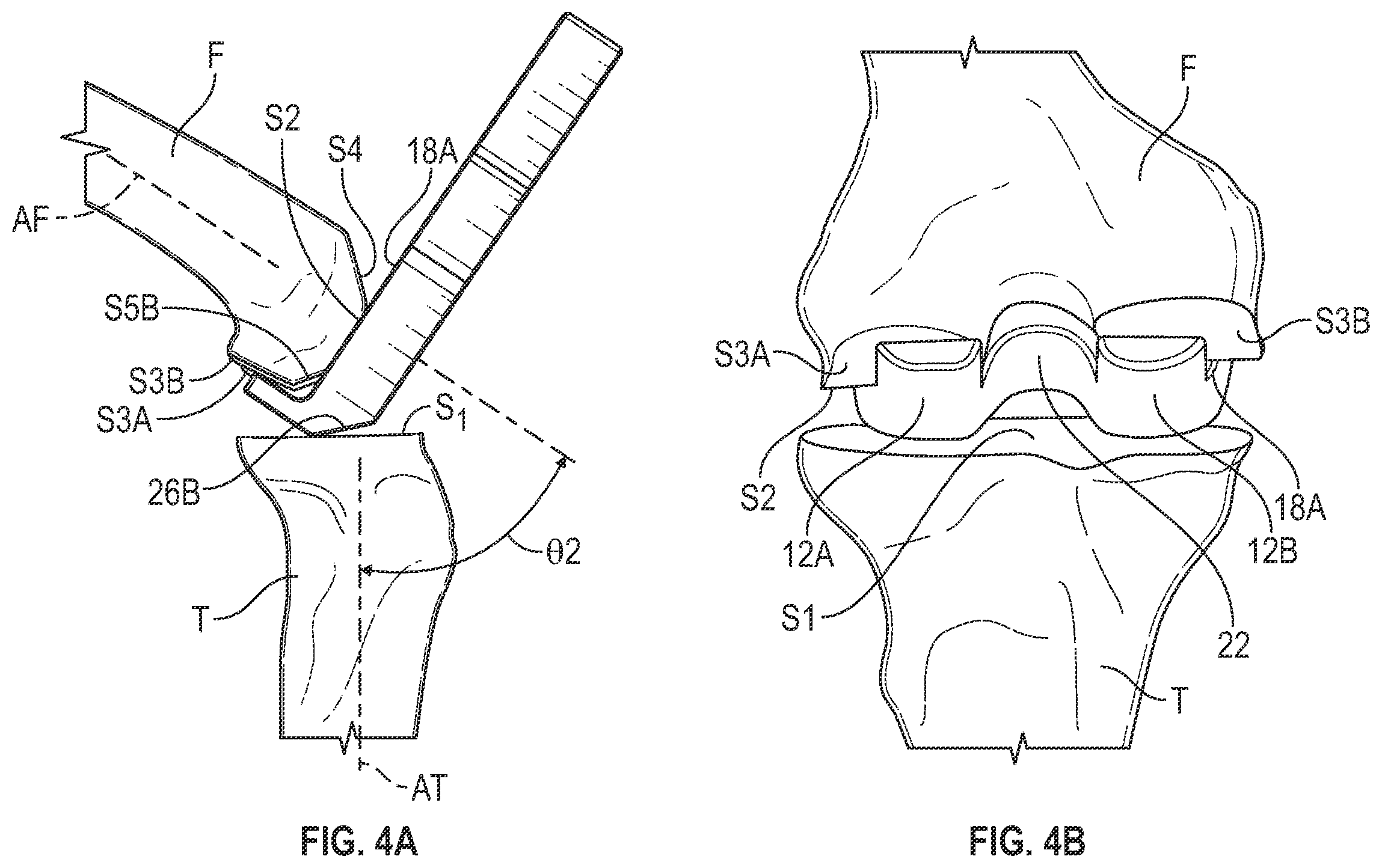 Patent US11793650 Figure 3 – Prosthetic knee implant systems and methods with linked tibial rotation