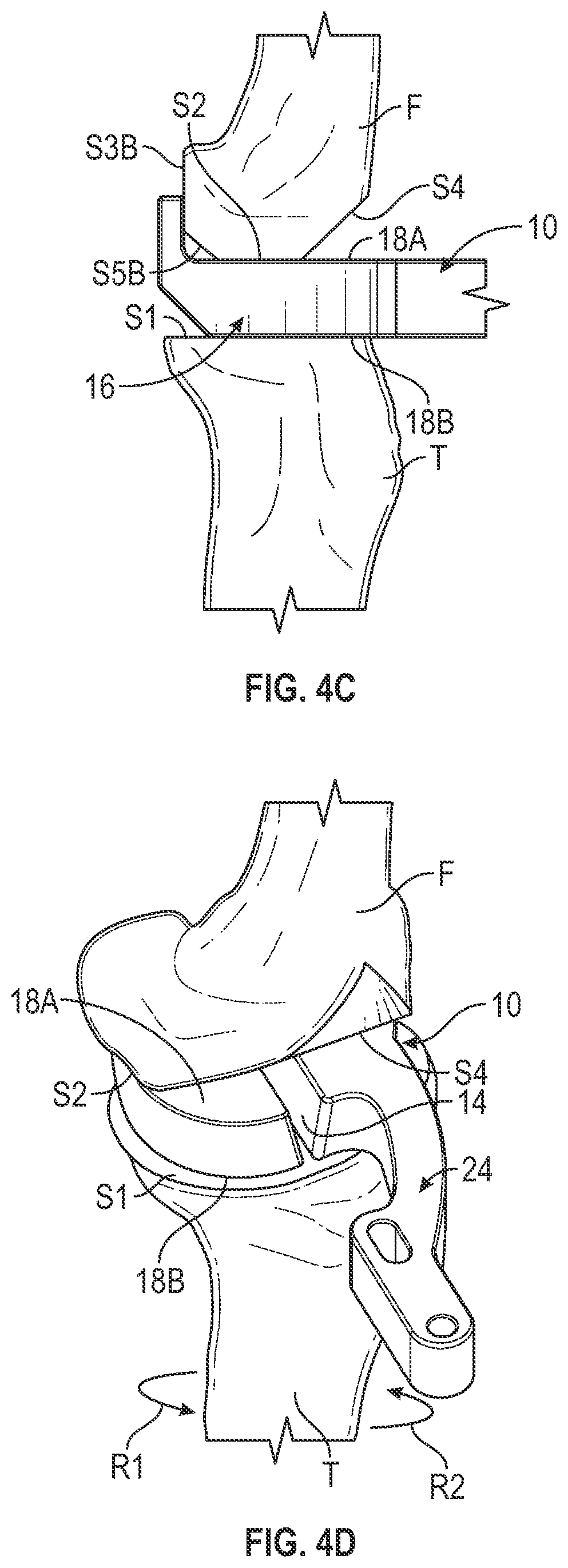 Patent US11793650 Figure 4 – Prosthetic knee implant systems and methods with linked tibial rotation