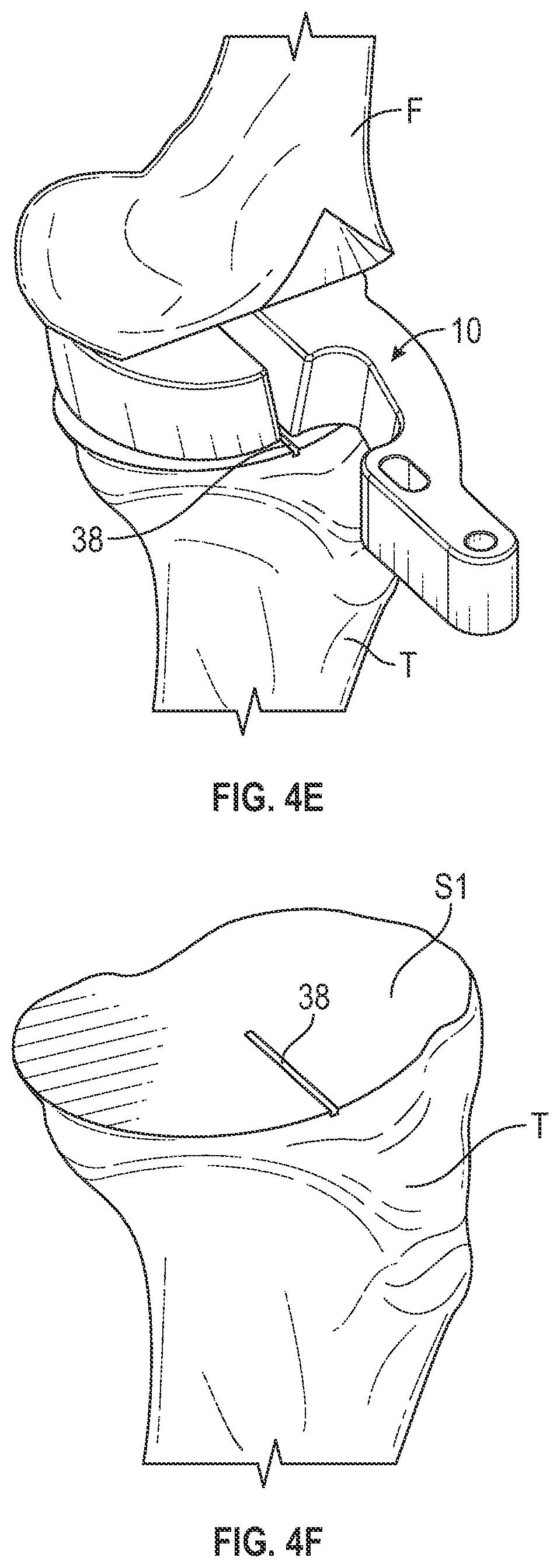 Patent US11793650 Figure 5 – Prosthetic knee implant systems and methods with linked tibial rotation