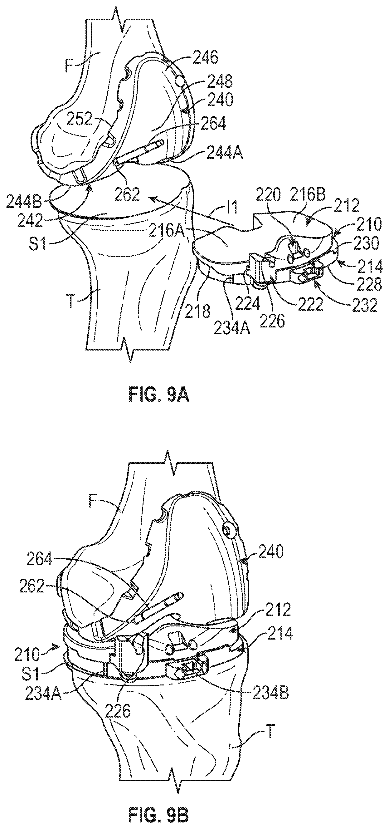 Patent US11793650 Figure 9 – Prosthetic knee implant systems and methods with linked tibial rotation