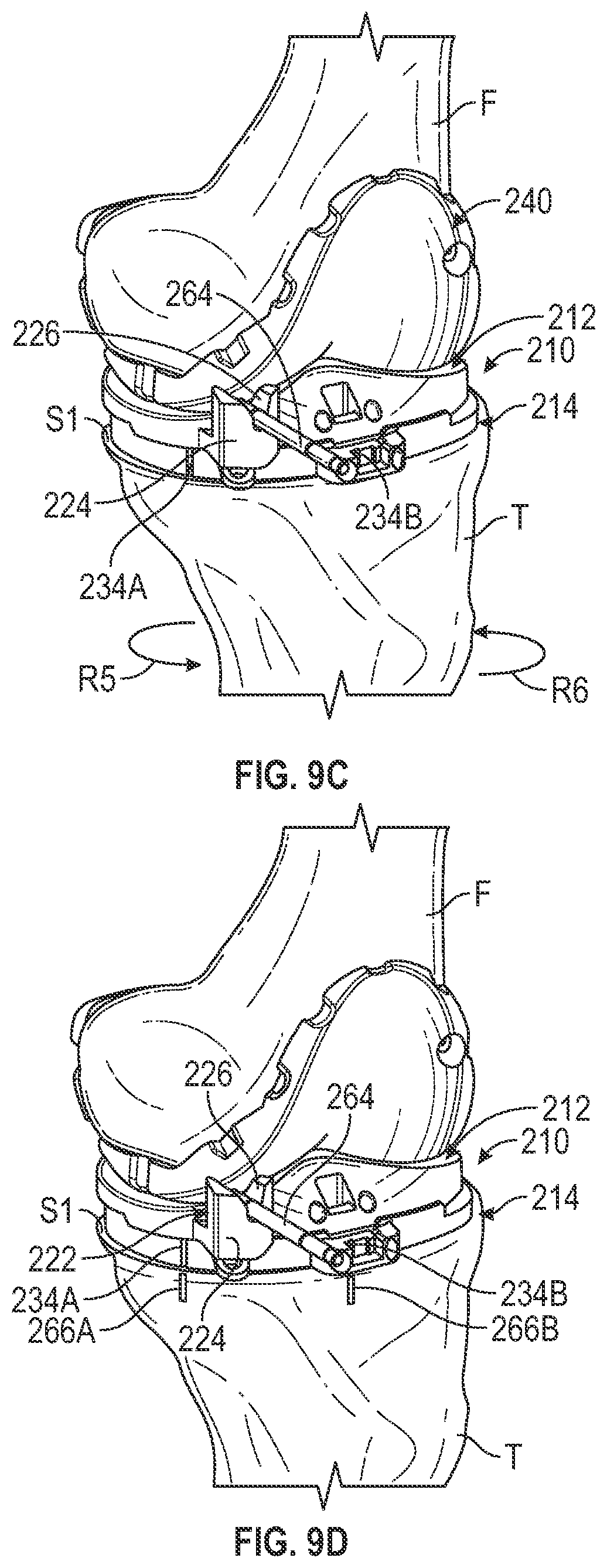 Patent US11793650 Figure 10 – Prosthetic knee implant systems and methods with linked tibial rotation