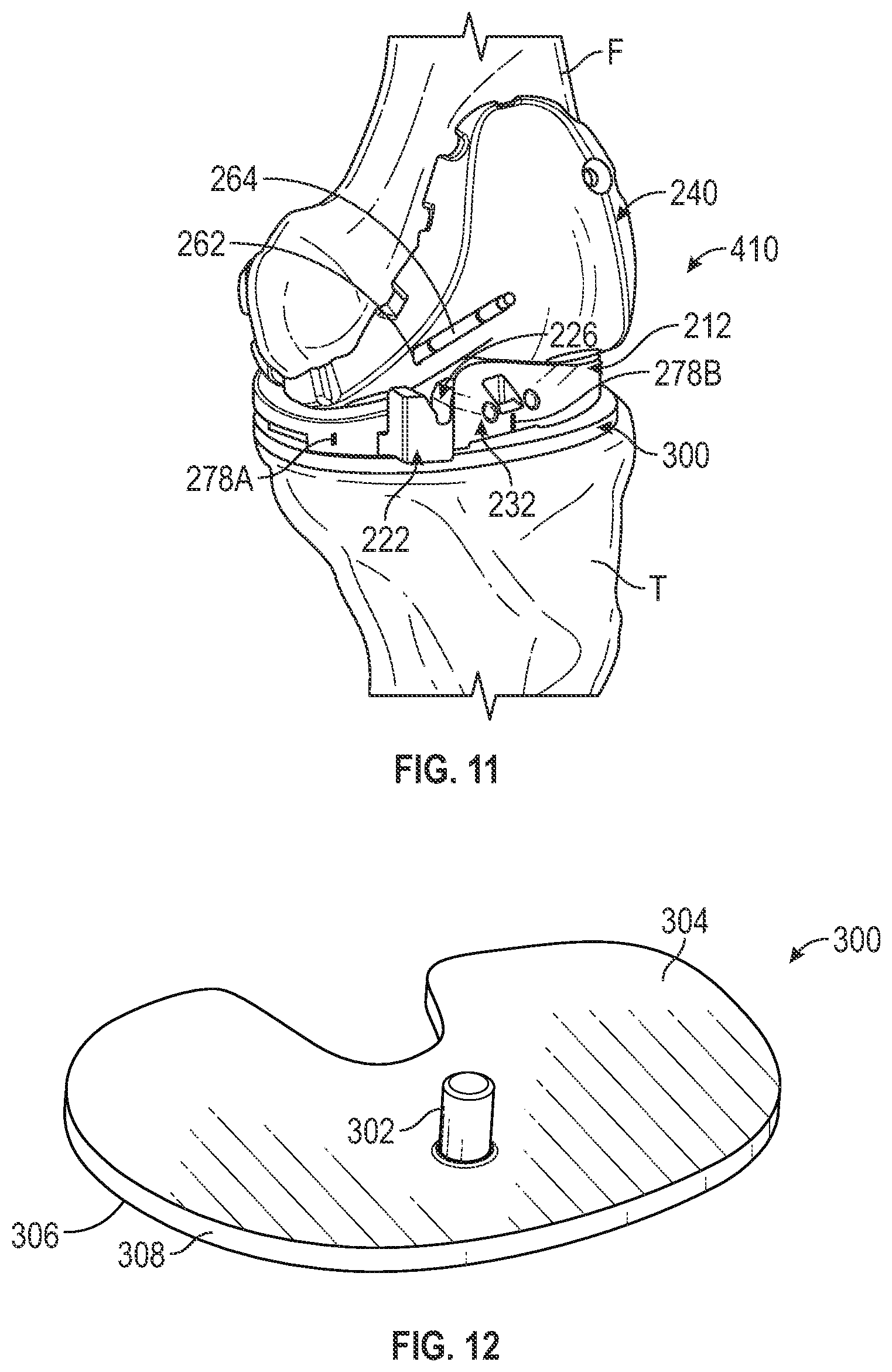 Patent US11793650 Figure 12 – Prosthetic knee implant systems and methods with linked tibial rotation