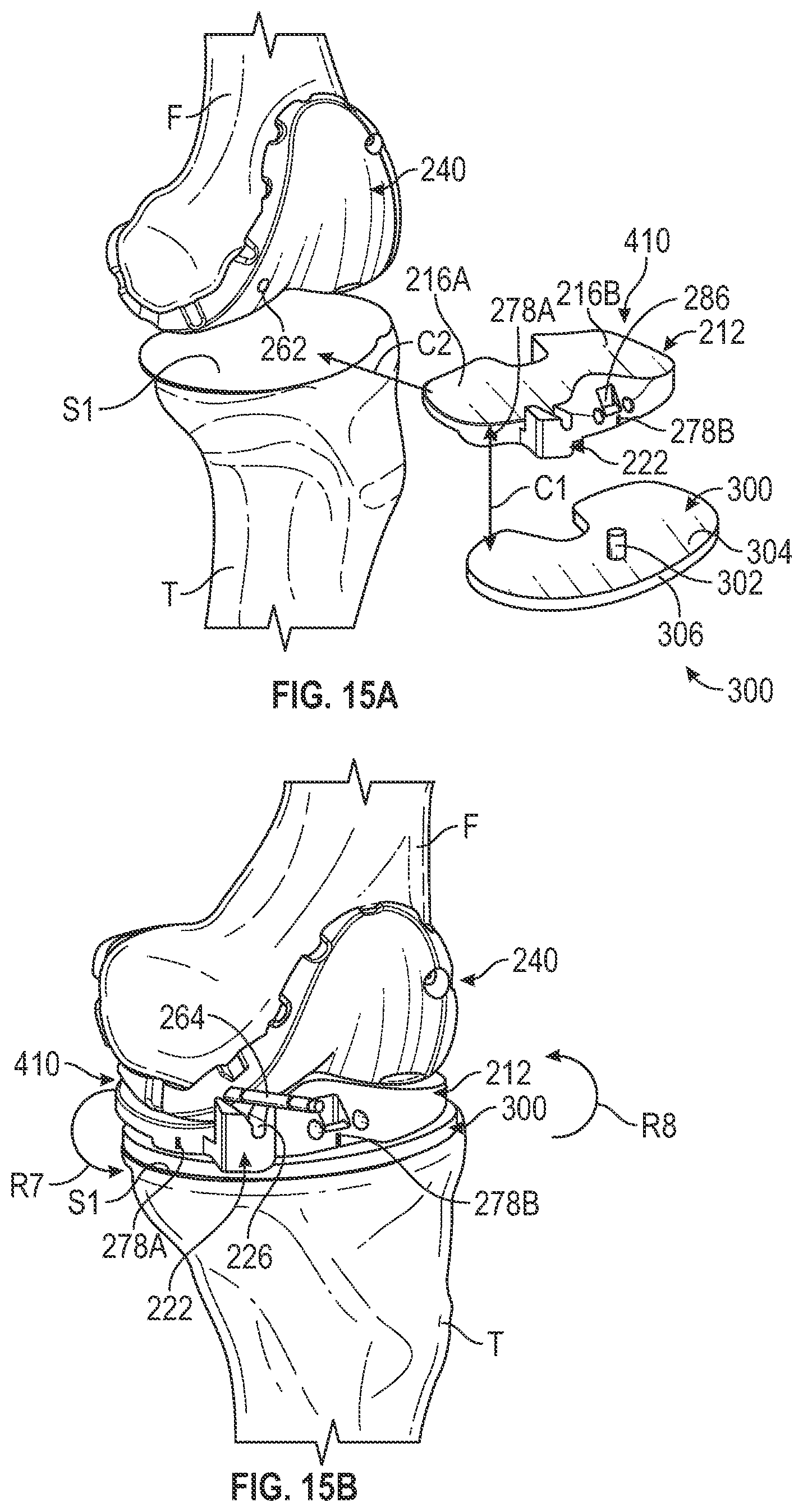 Patent US11793650 Figure 14 – Prosthetic knee implant systems and methods with linked tibial rotation