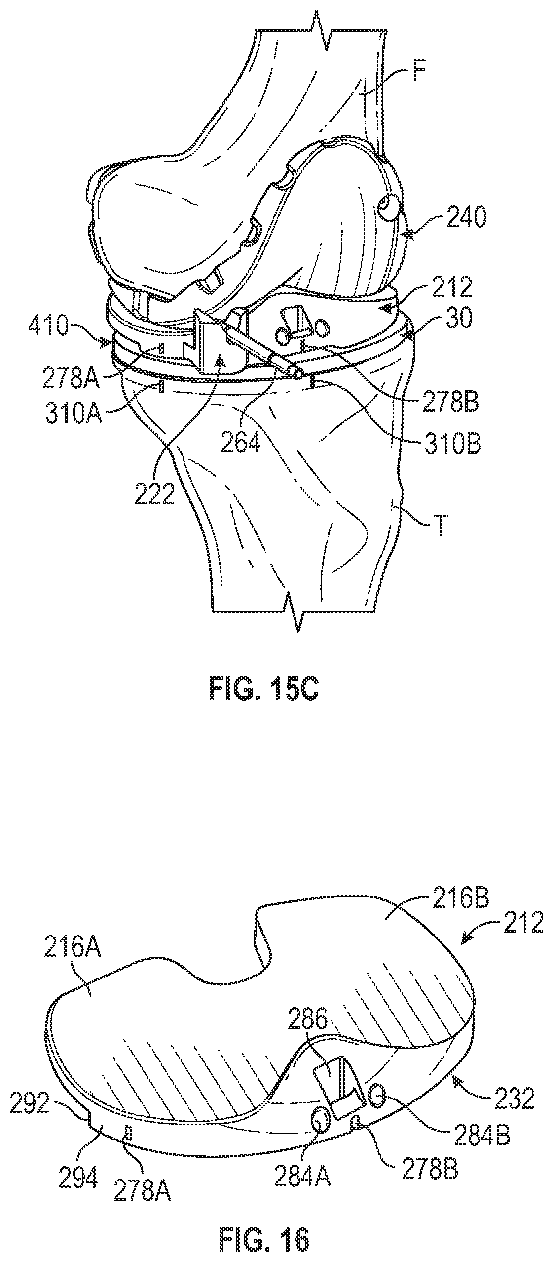 Patent US11793650 Figure 15 – Prosthetic knee implant systems and methods with linked tibial rotation