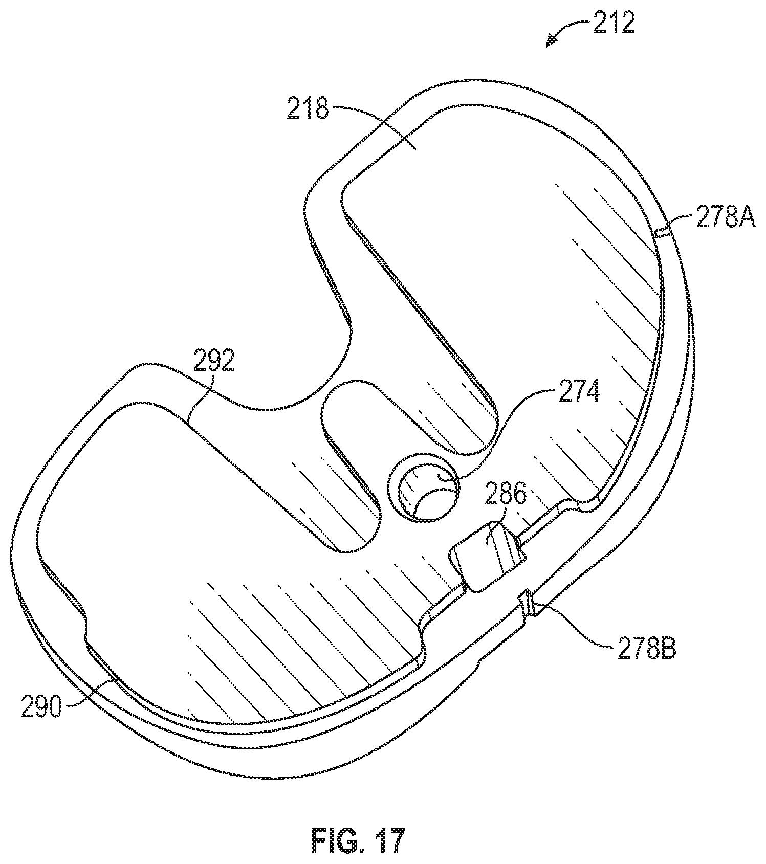 Patent US11793650 Figure 16 – Prosthetic knee implant systems and methods with linked tibial rotation