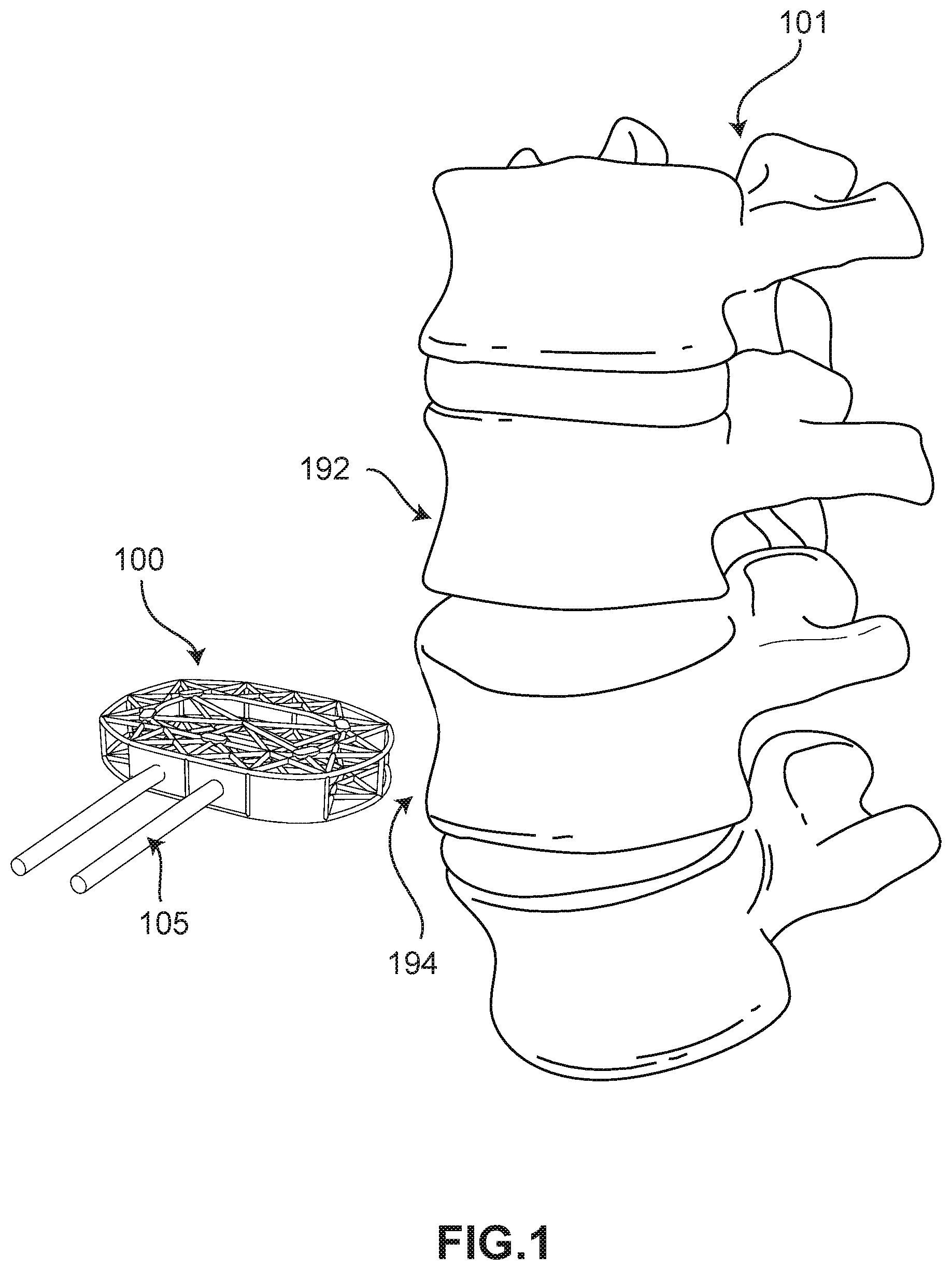 Patent US11793652 Figure 1 – Implant with improved bone contact