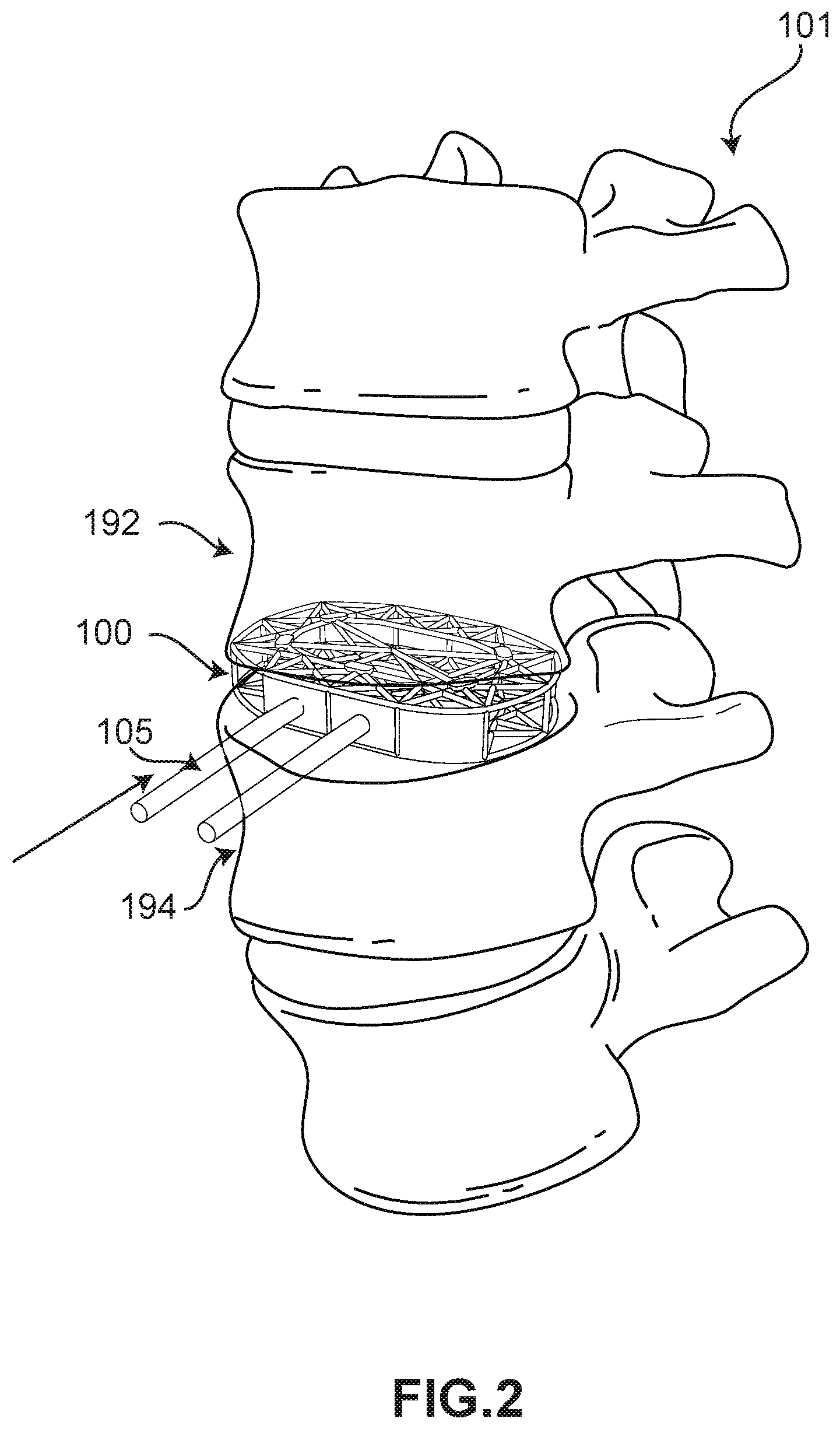 Patent US11793652 Figure 2 – Implant with improved bone contact