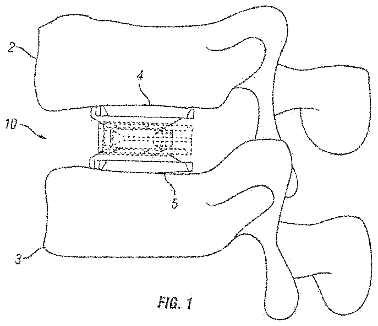 Patent US11793654 Figure 1 – Expandable fusion device and method of installation thereof