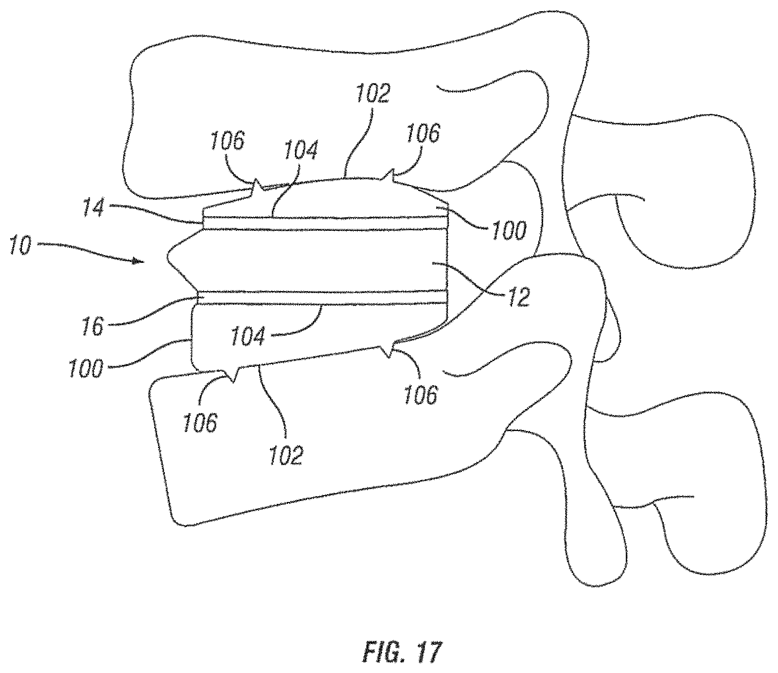Patent US11793654 Figure 9 – Expandable fusion device and method of installation thereof