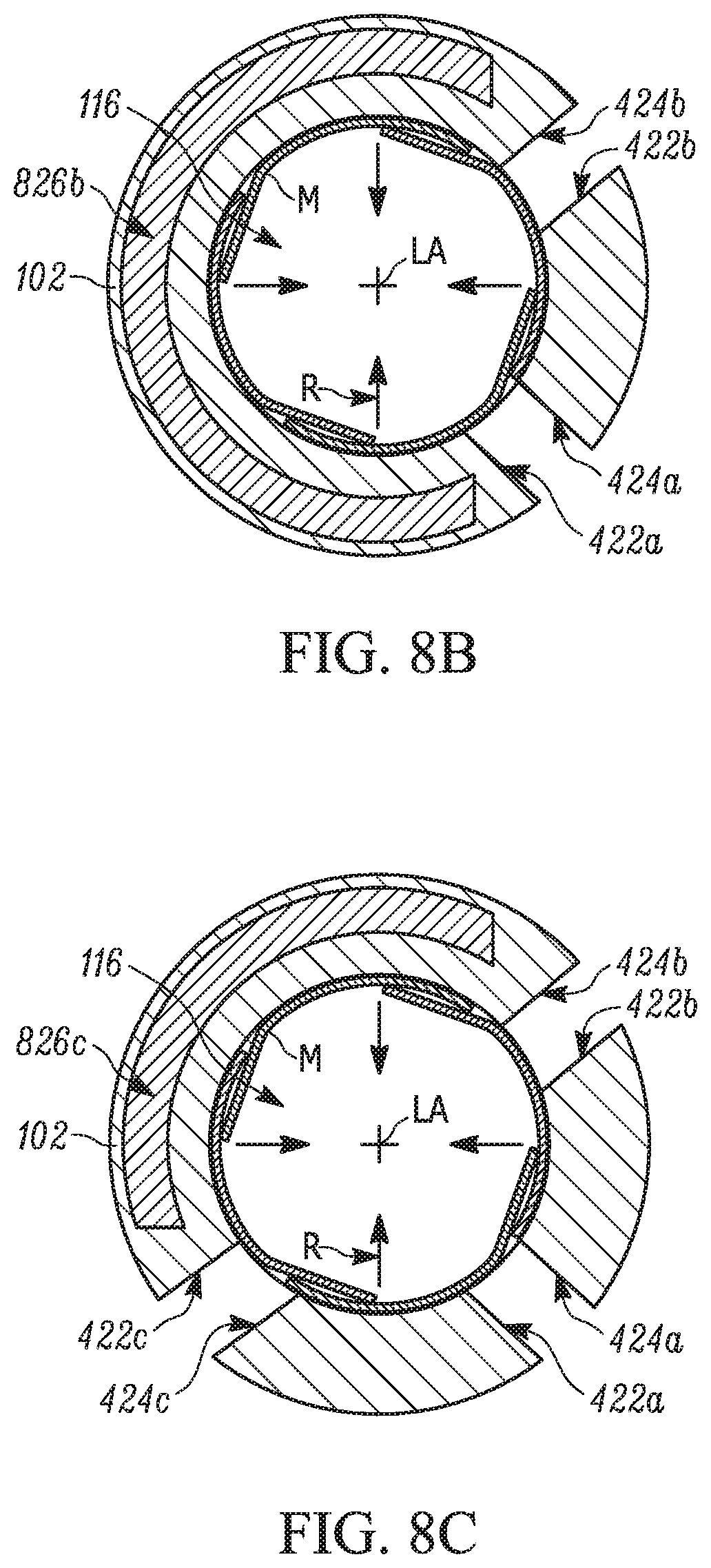 Patent US11793658 Figure 6 – Method and apparatuses for deploying an implant