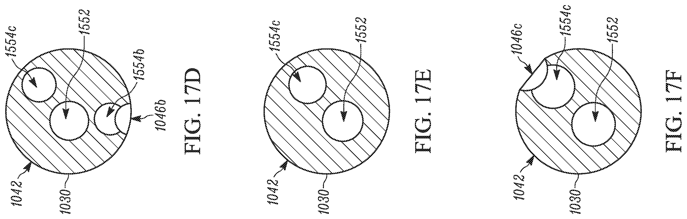 Patent US11793658 Figure 20 – Method and apparatuses for deploying an implant