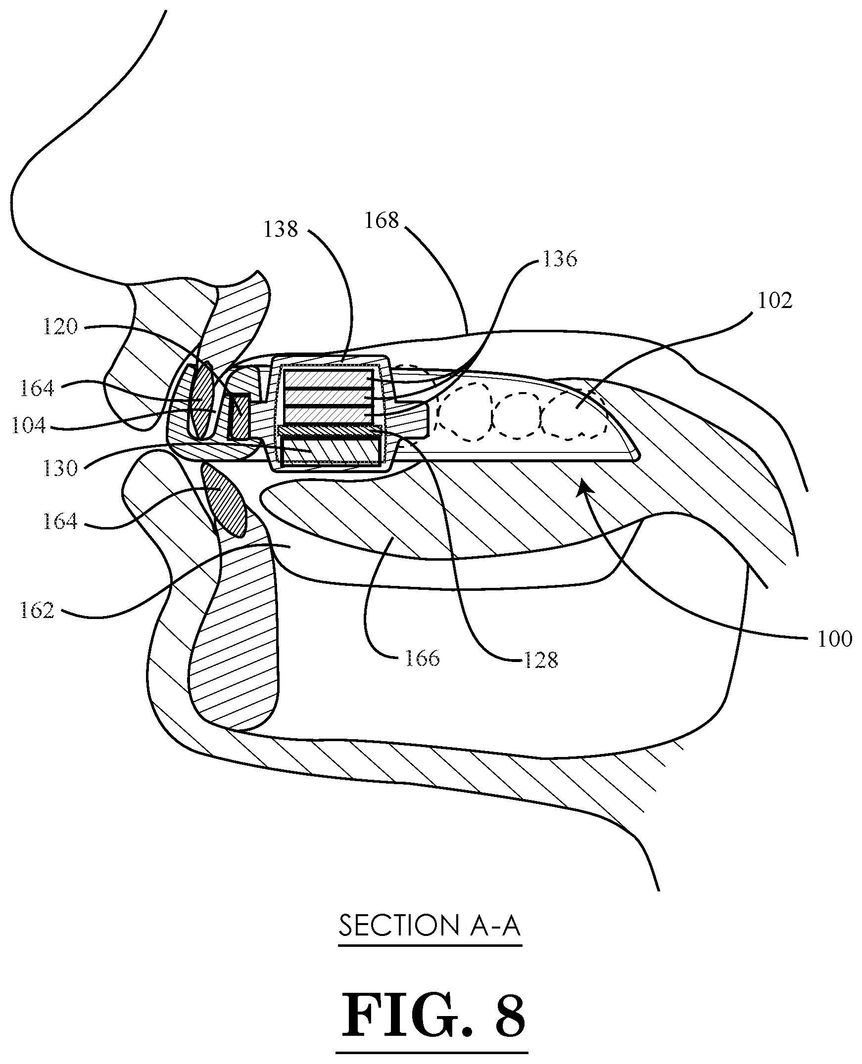 Patent US11793664 Figure 7 – Bruxism mouth guard device