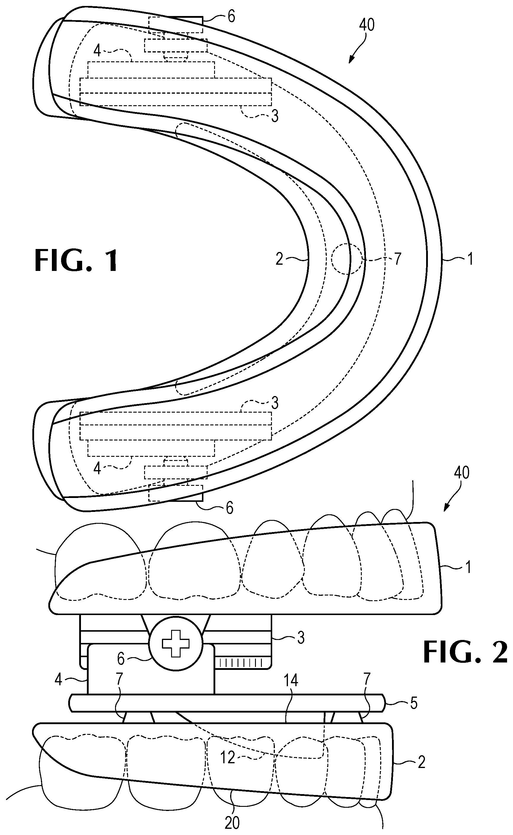 Patent US11793666 — Intra-oral snore and sleep apnea treatment appliance — Figure 1