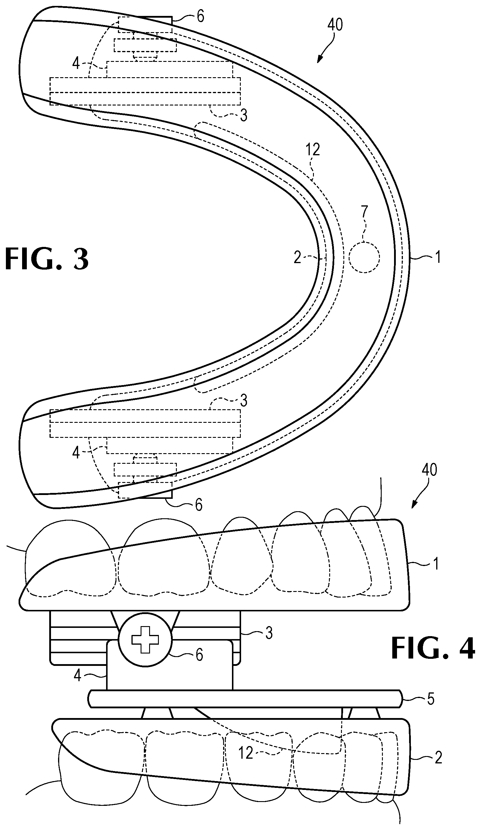 Patent US11793666 Figure 2 – Intra-oral snore and sleep apnea treatment appliance