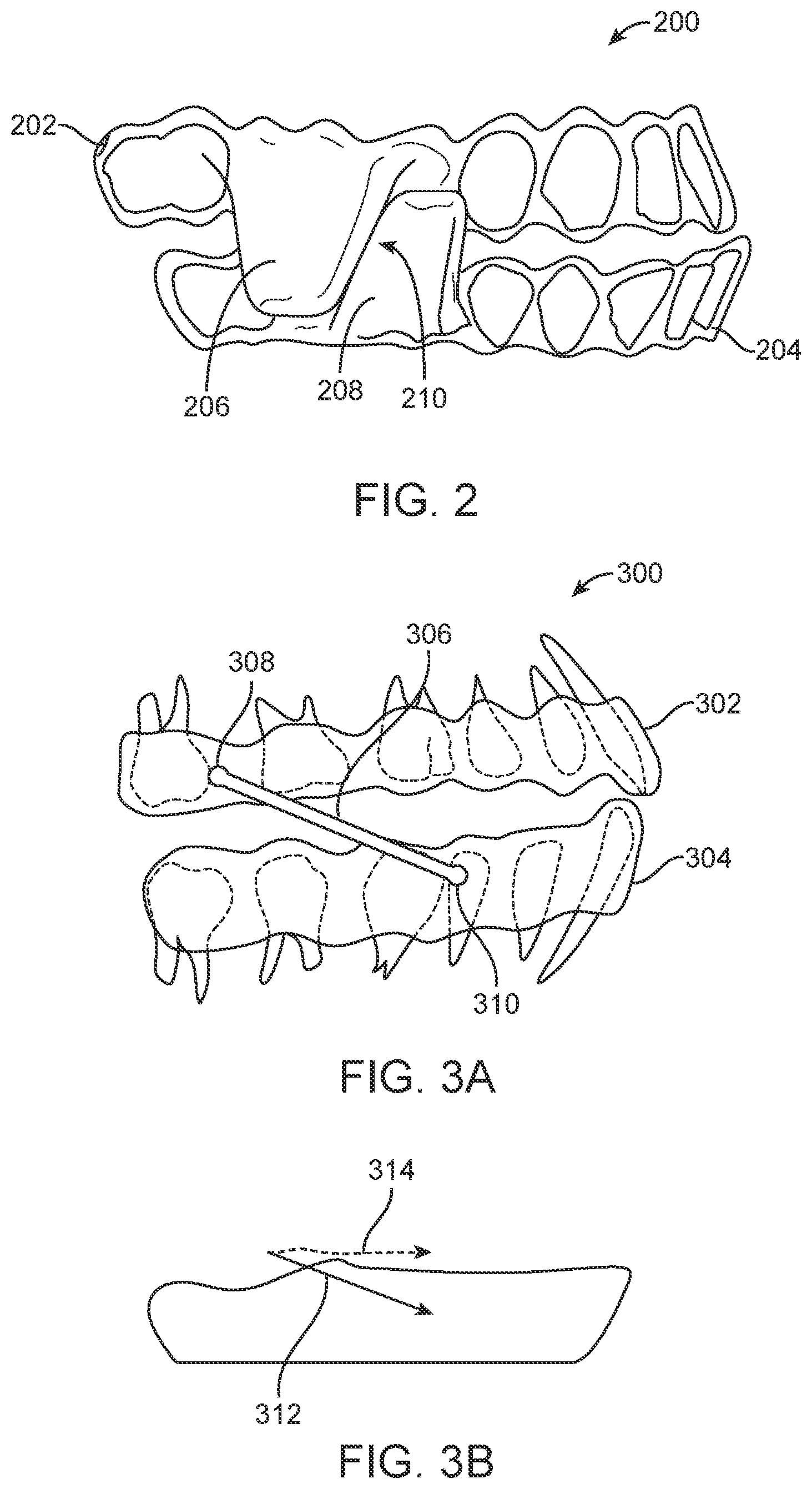 Patent US11793667 Figure 2 – Systems, methods, and devices for applying distributed forces for mandibular advancement