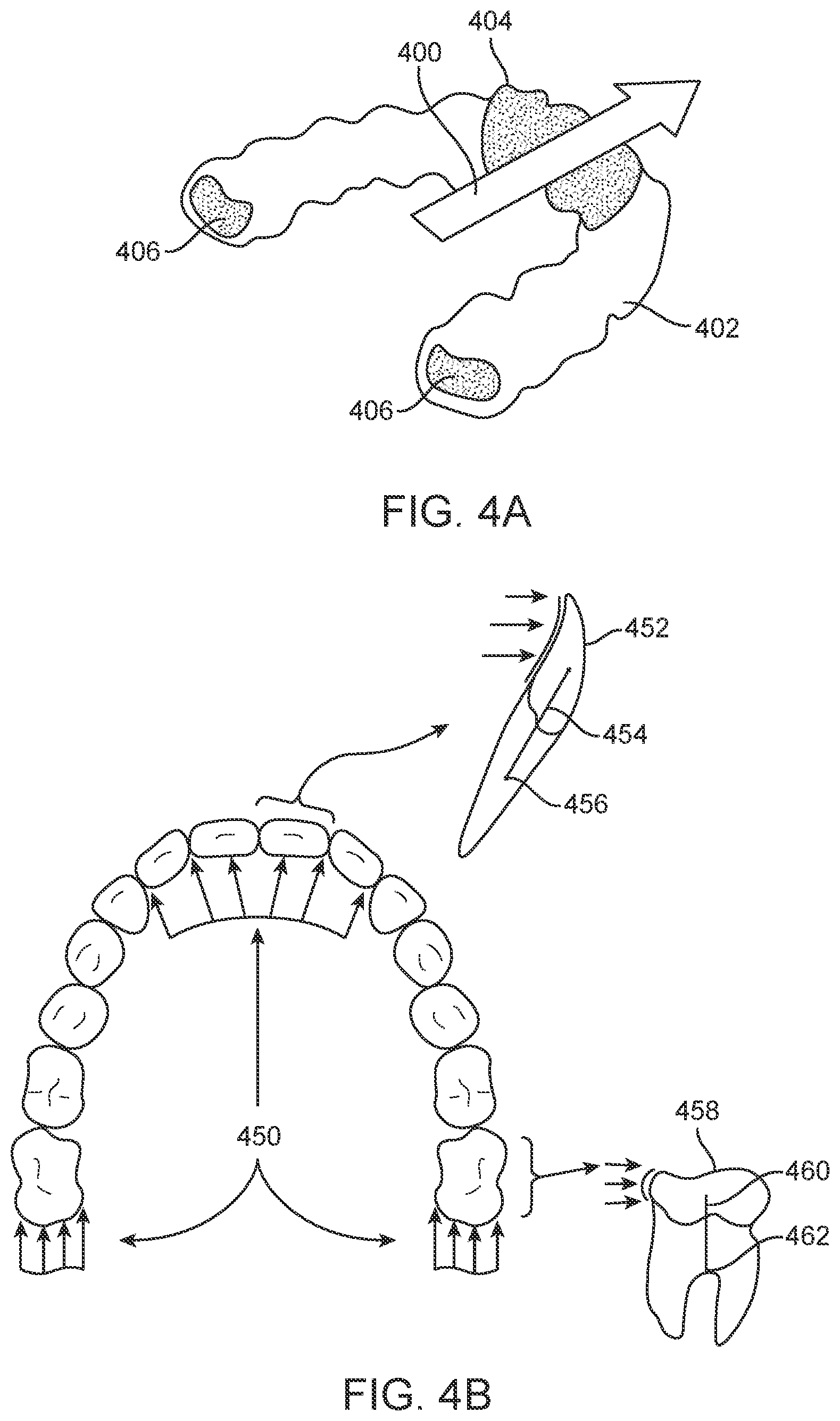 Patent US11793667 Figure 3 – Systems, methods, and devices for applying distributed forces for mandibular advancement