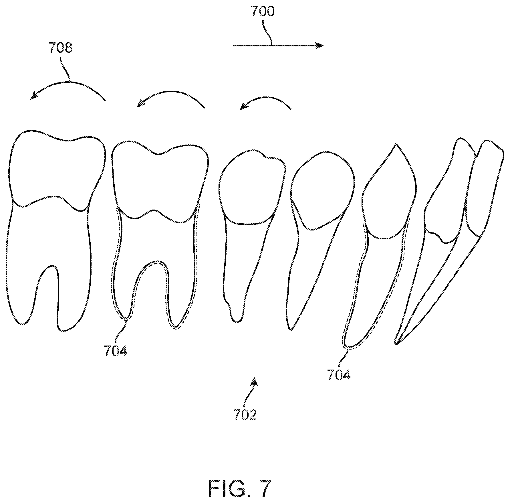 Patent US11793667 Figure 6 – Systems, methods, and devices for applying distributed forces for mandibular advancement