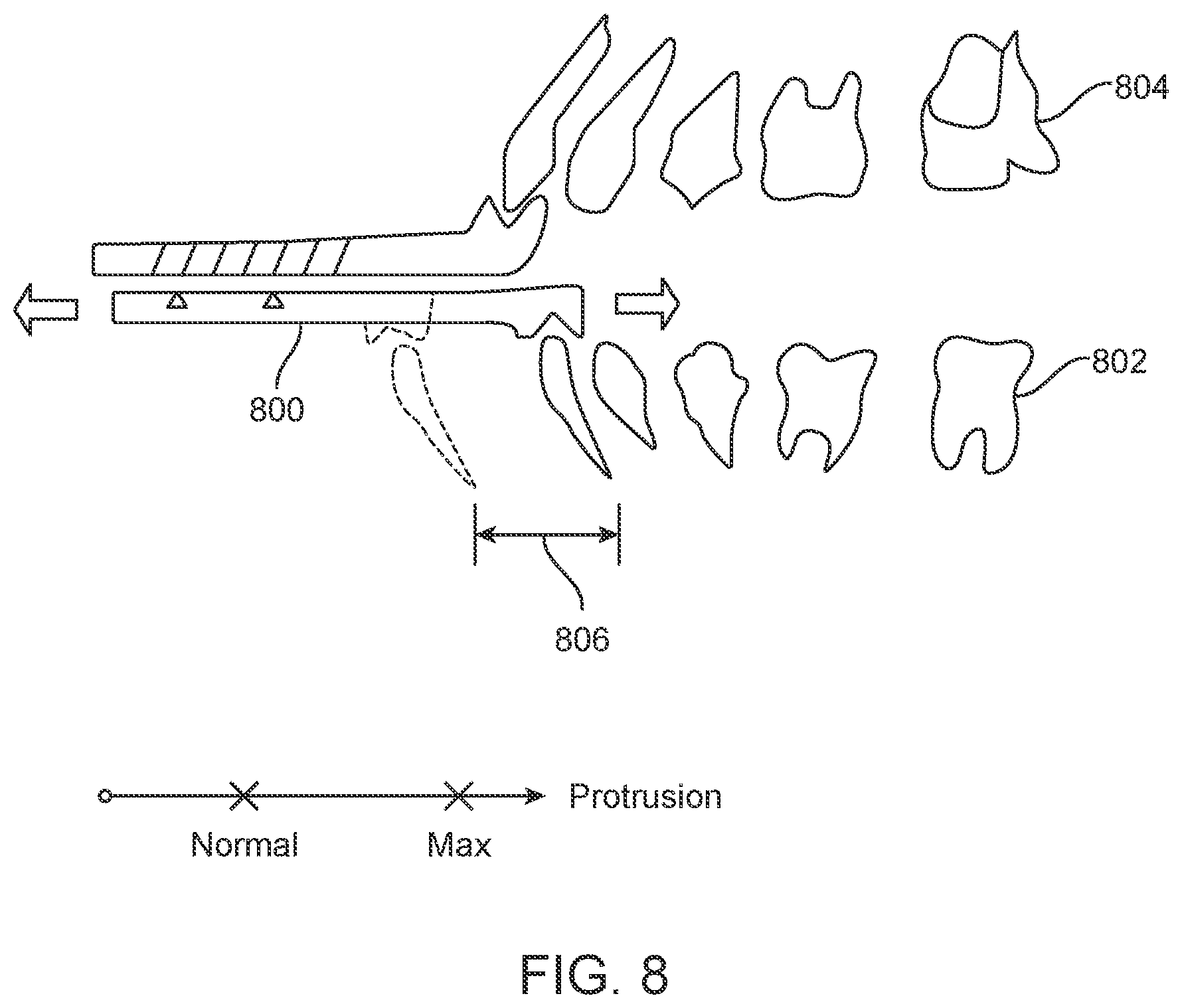 Patent US11793667 Figure 7 – Systems, methods, and devices for applying distributed forces for mandibular advancement