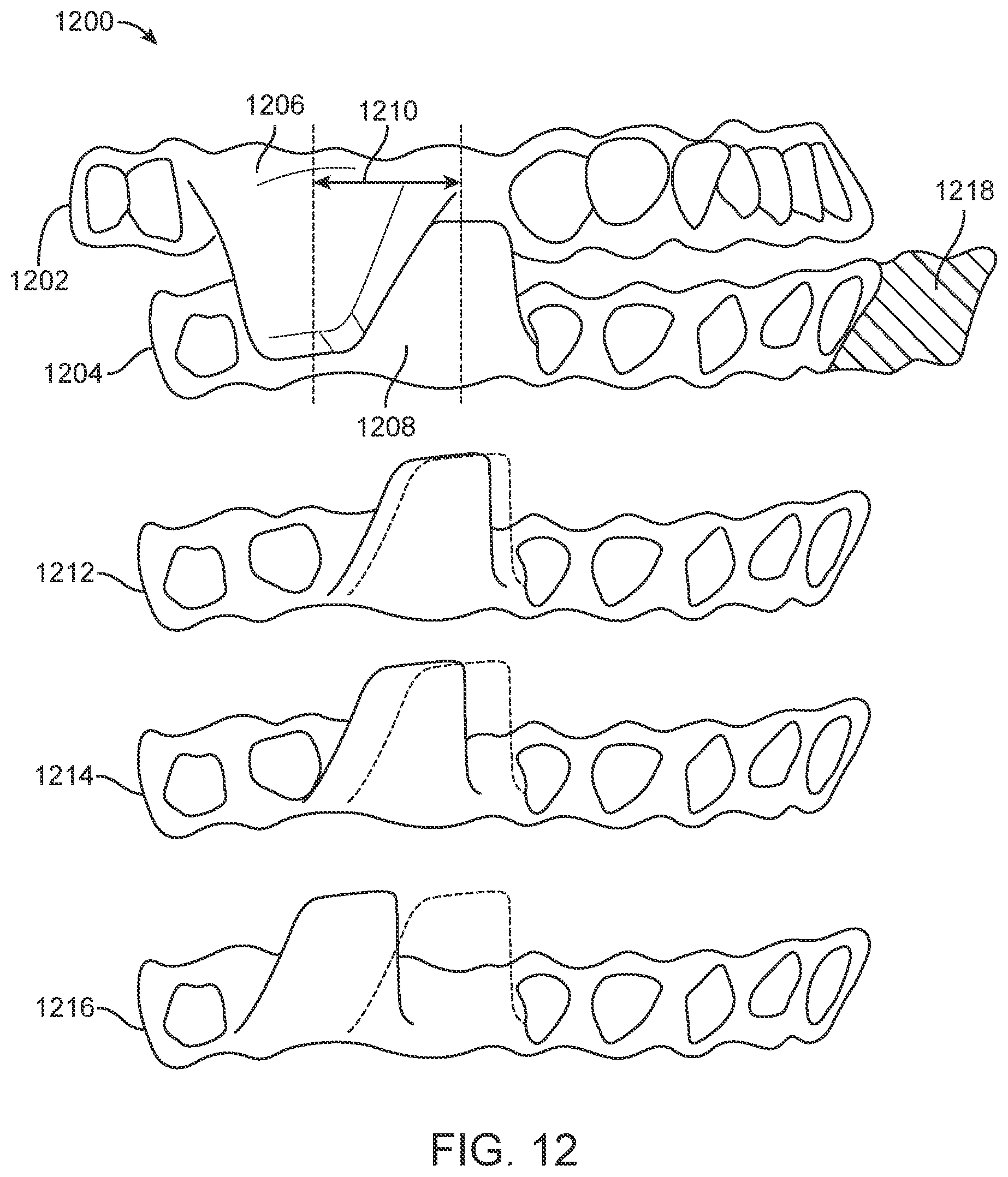 Patent US11793667 Figure 10 – Systems, methods, and devices for applying distributed forces for mandibular advancement