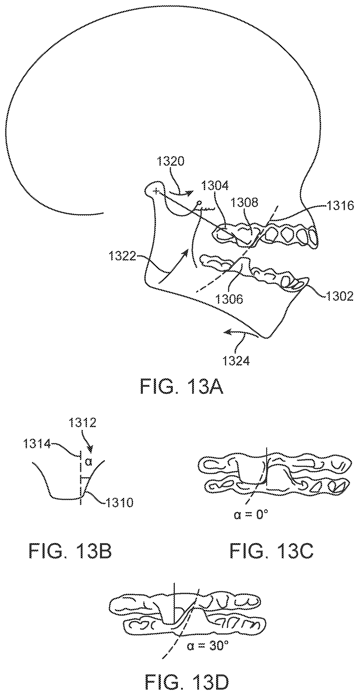 Patent US11793667 Figure 11 – Systems, methods, and devices for applying distributed forces for mandibular advancement