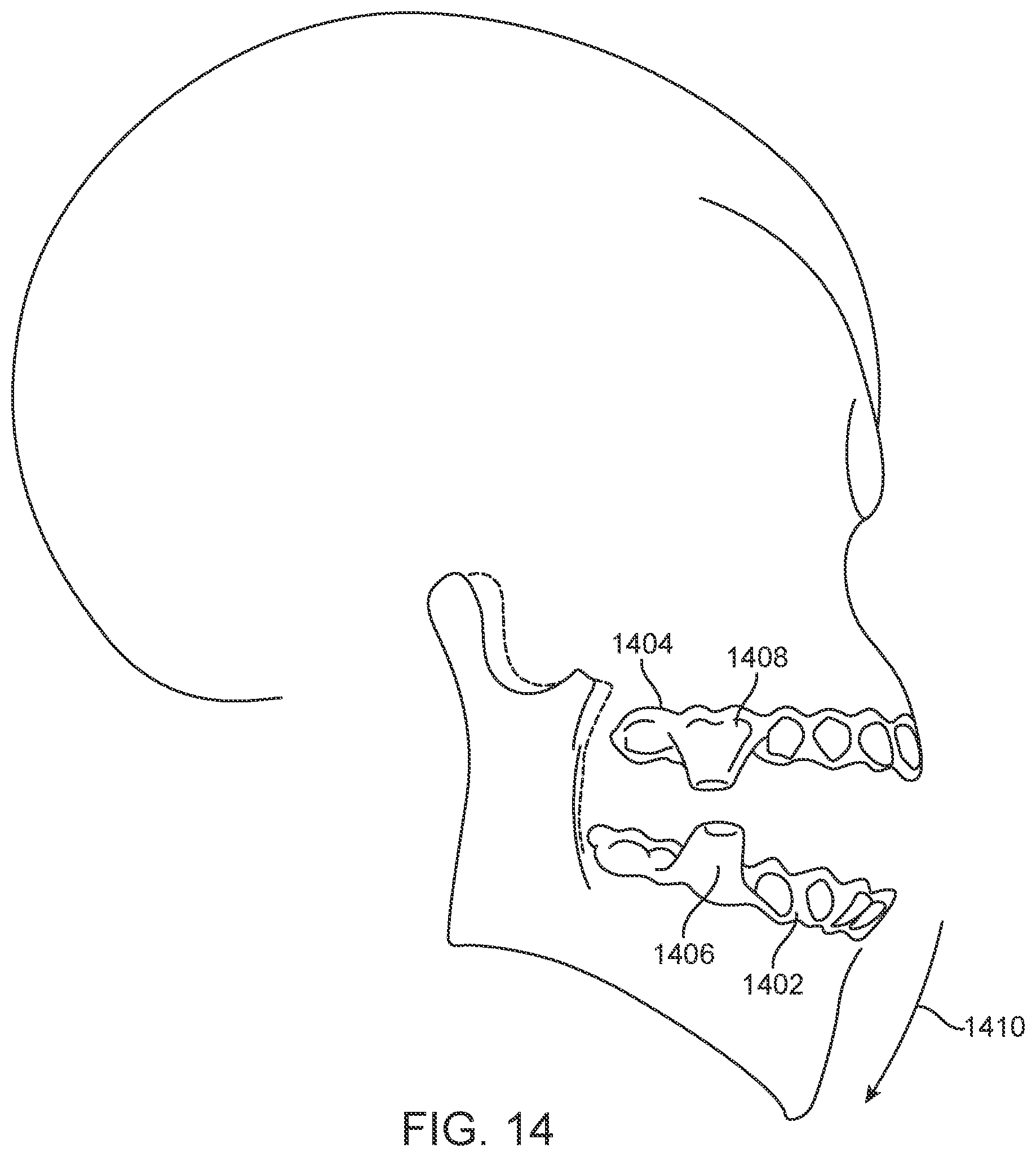 Patent US11793667 Figure 12 – Systems, methods, and devices for applying distributed forces for mandibular advancement