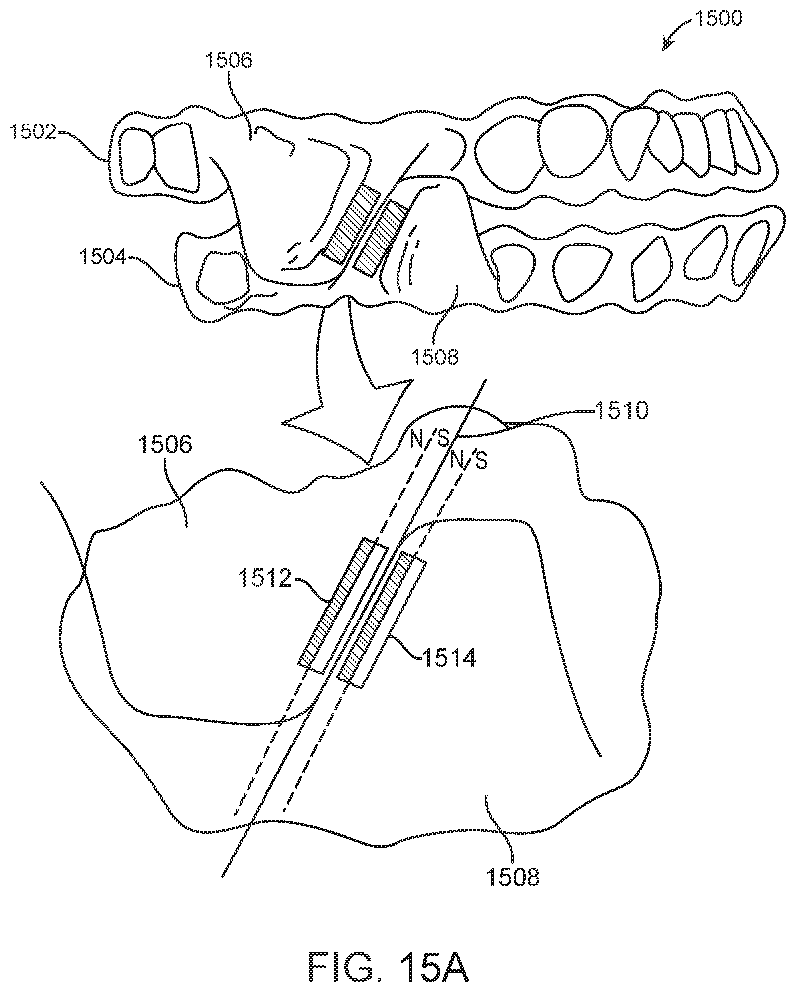 Patent US11793667 Figure 13 – Systems, methods, and devices for applying distributed forces for mandibular advancement