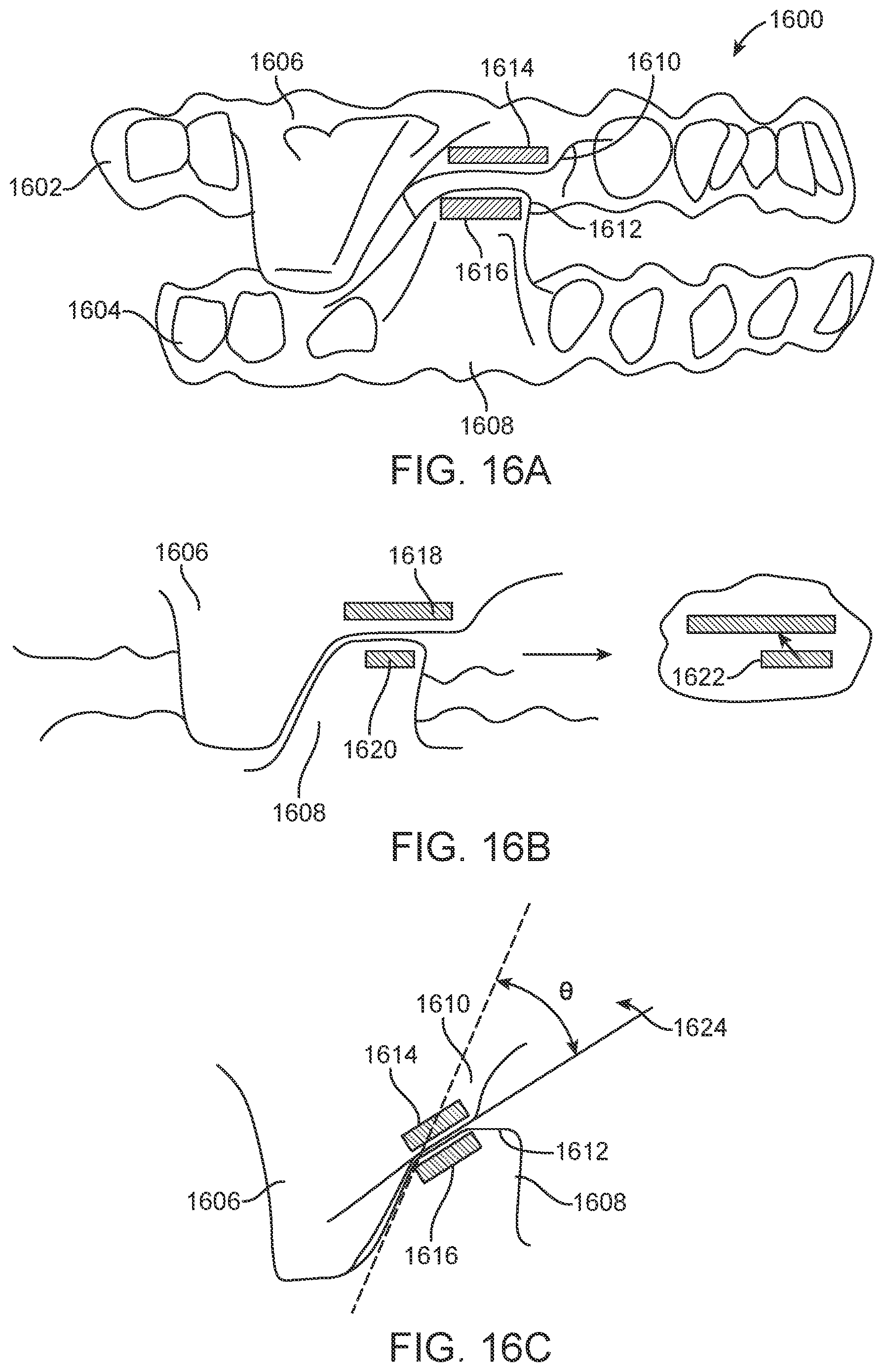 Patent US11793667 Figure 15 – Systems, methods, and devices for applying distributed forces for mandibular advancement