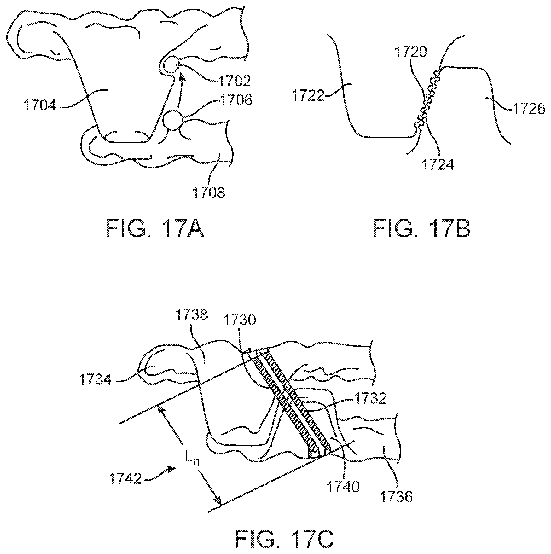 Patent US11793667 Figure 16 – Systems, methods, and devices for applying distributed forces for mandibular advancement
