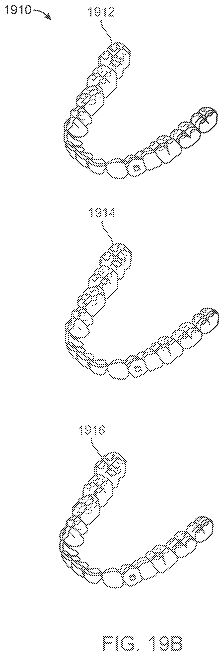 Patent US11793667 Figure 19 – Systems, methods, and devices for applying distributed forces for mandibular advancement