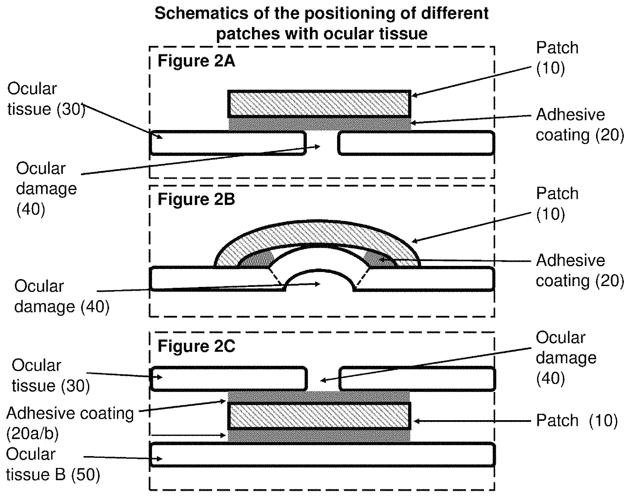 Patent US11793672 Figure 2 – Polymer substrate retinal patch coated with adhesives