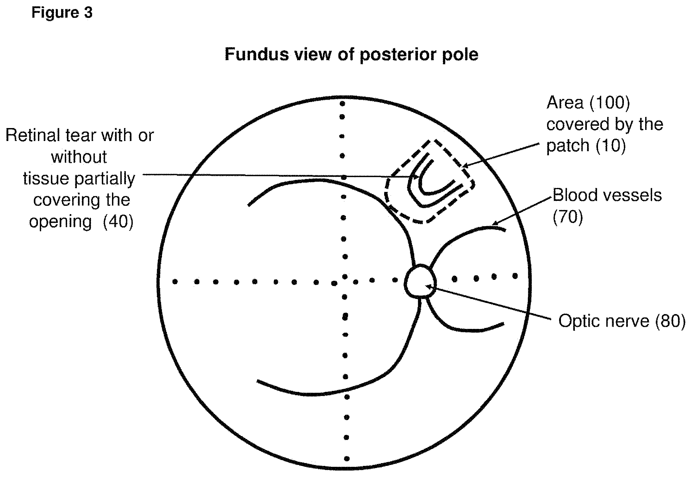 Patent US11793672 Figure 3 – Polymer substrate retinal patch coated with adhesives