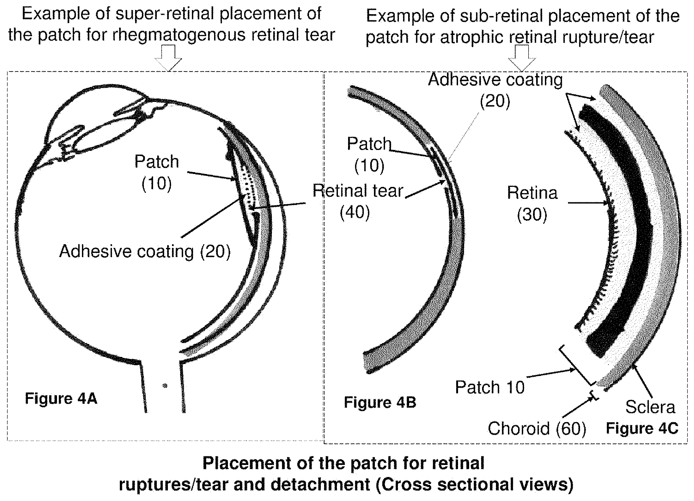 Patent US11793672 Figure 4 – Polymer substrate retinal patch coated with adhesives