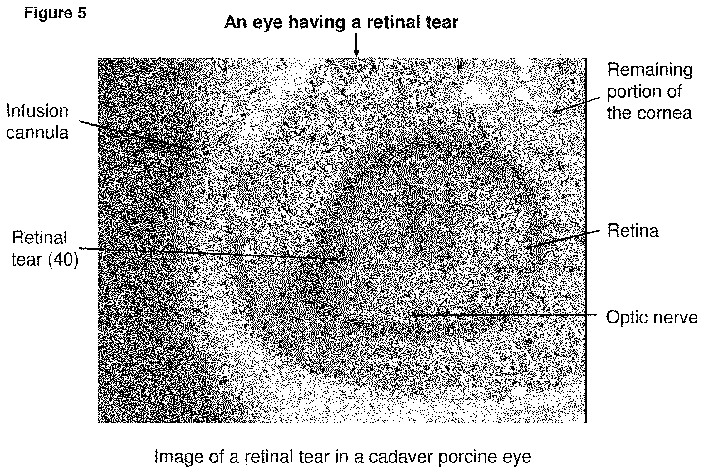 Patent US11793672 Figure 5 – Polymer substrate retinal patch coated with adhesives