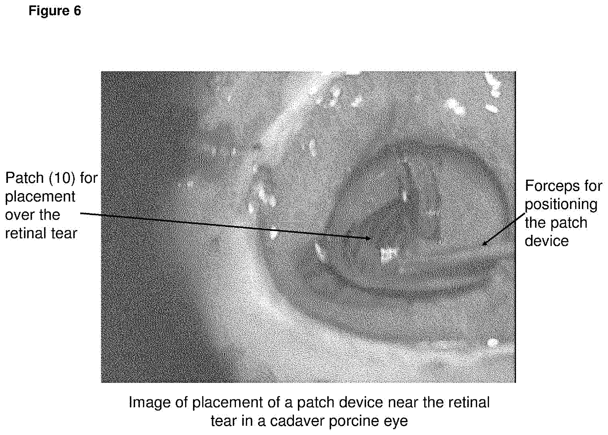 Patent US11793672 Figure 6 – Polymer substrate retinal patch coated with adhesives