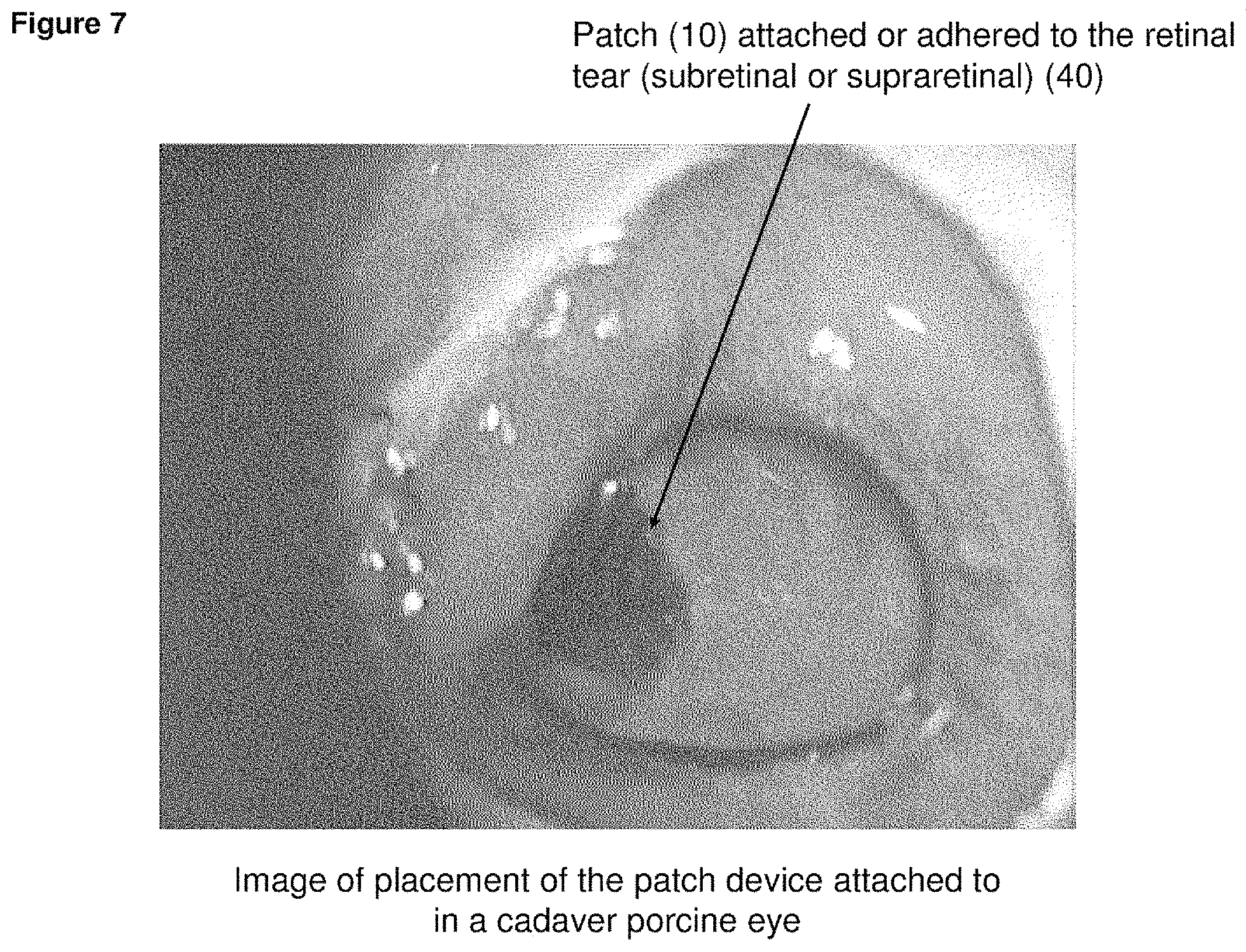 Patent US11793672 Figure 7 – Polymer substrate retinal patch coated with adhesives