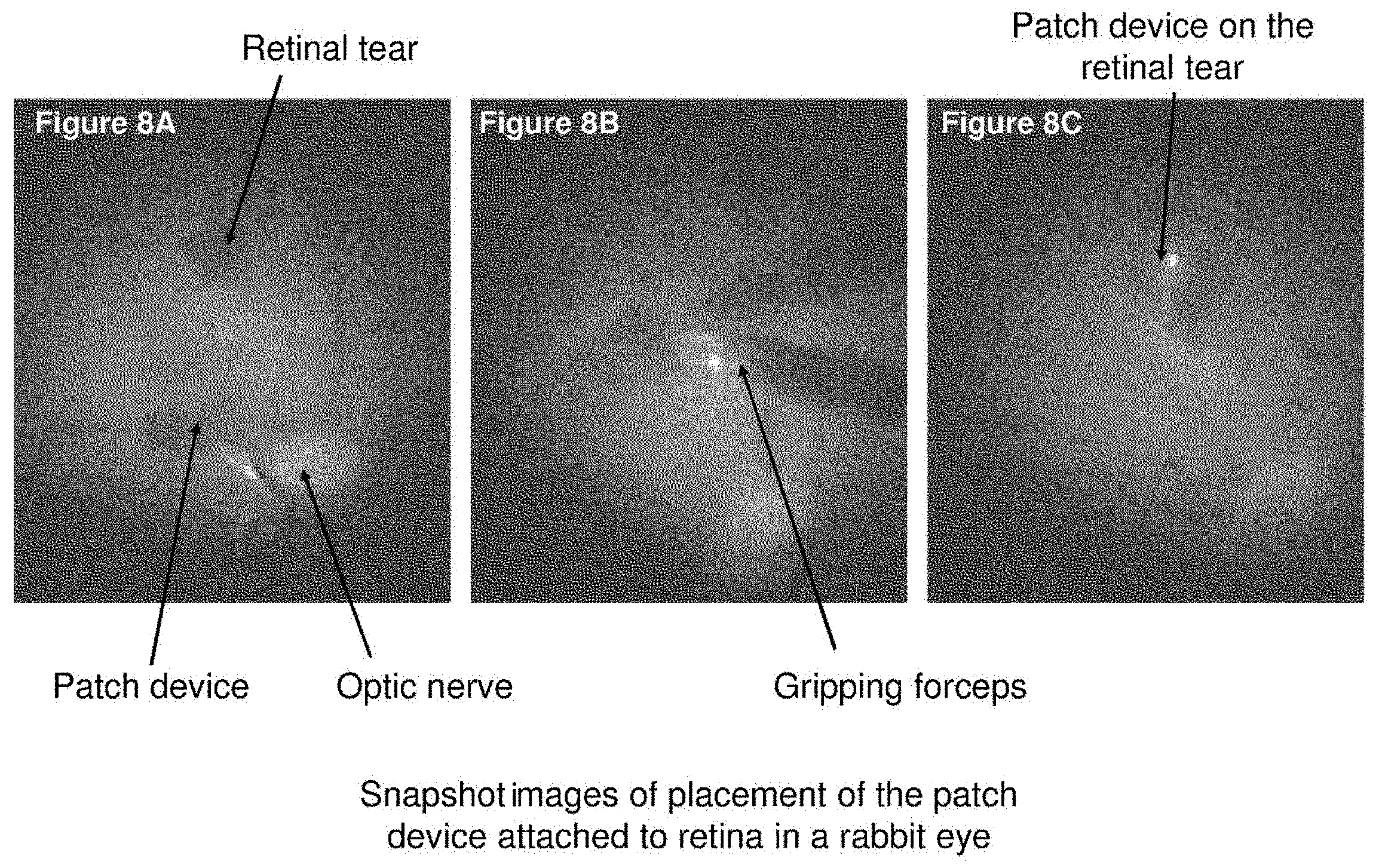 Patent US11793672 Figure 8 – Polymer substrate retinal patch coated with adhesives