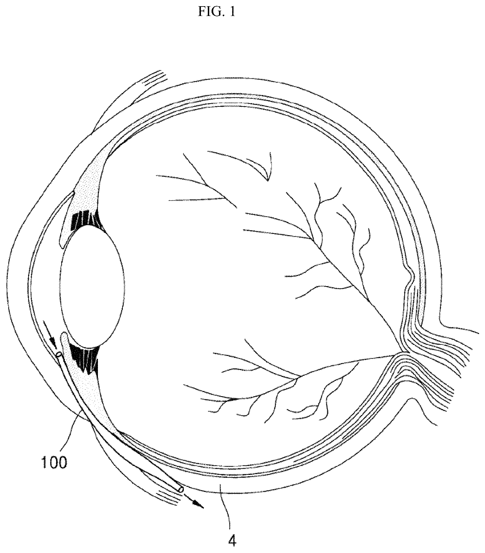 Patent US11793673 Figure 1 – Implant device for eye disease for adjusting intraocular pressure