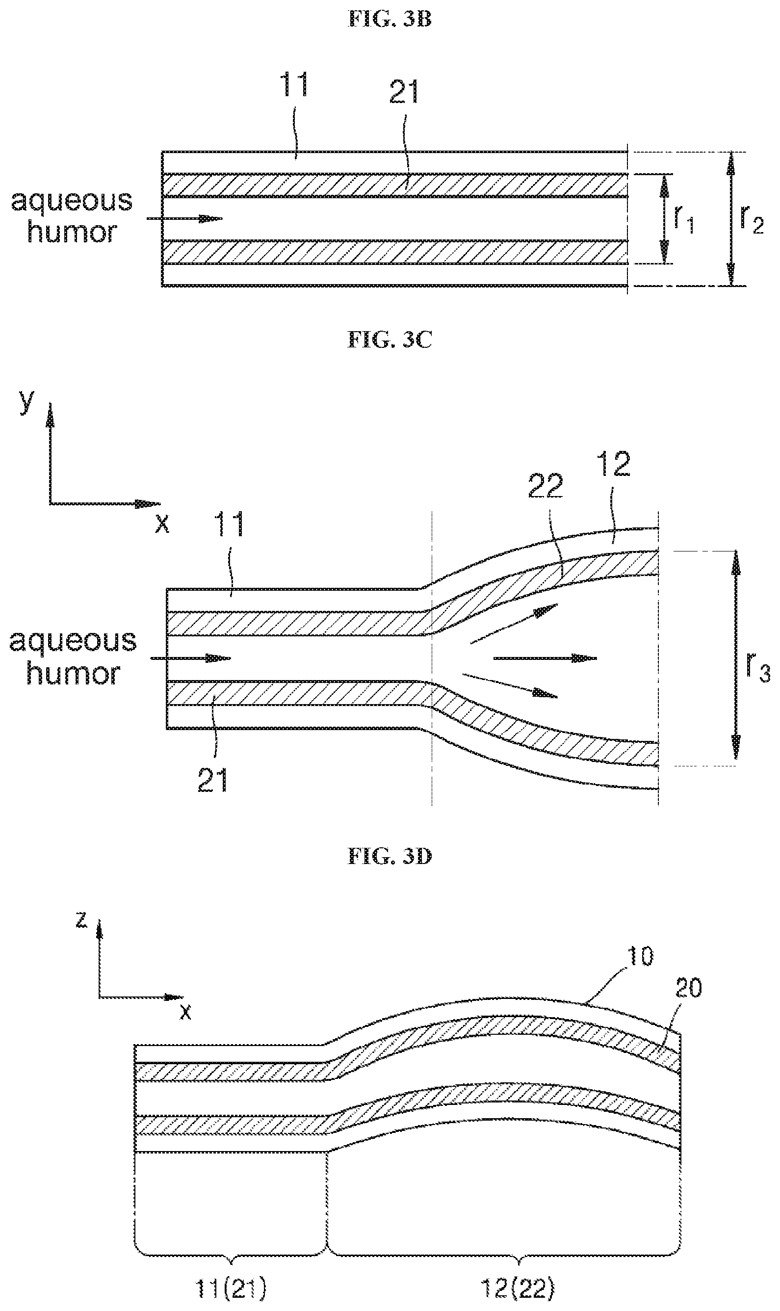 Patent US11793673 Figure 3 – Implant device for eye disease for adjusting intraocular pressure