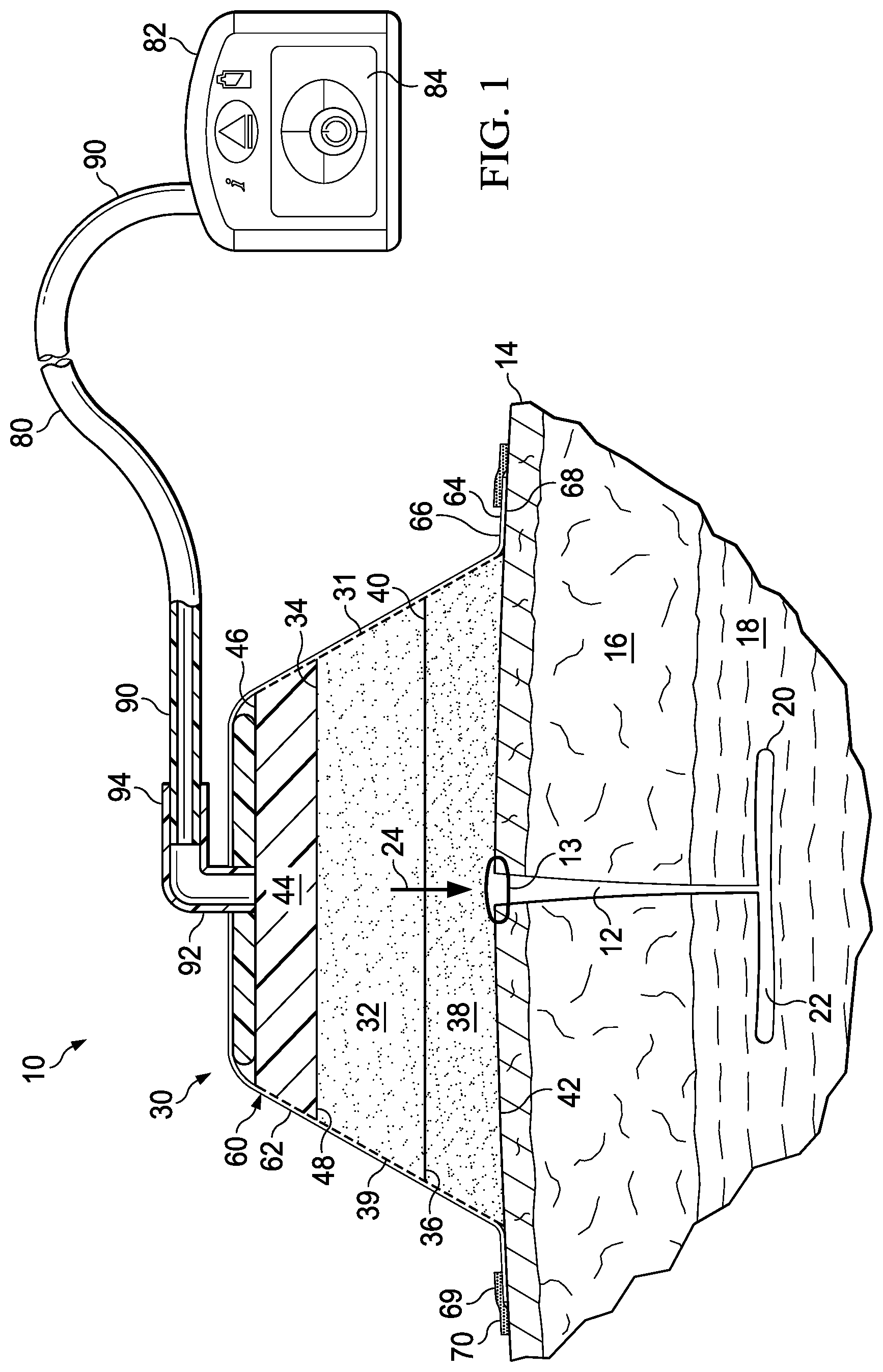 Patent US11793679 — Super-absorbent, reduced-pressure wound dressing and systems — Figure 1